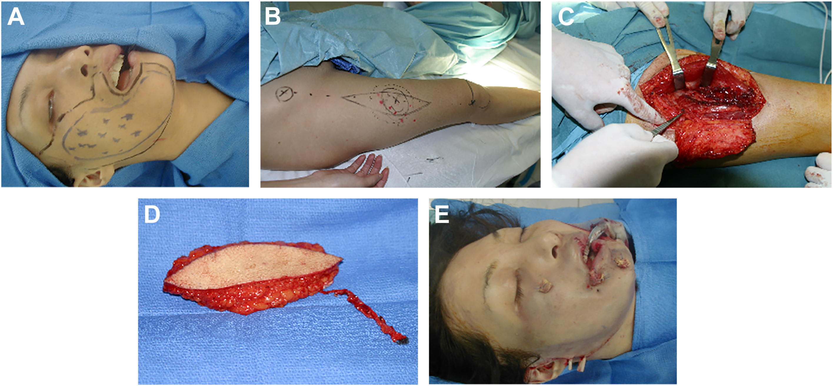 Five surgical photographs show the correction of hemi-facial atrophy using an anterolateral thigh perforator flap to restore contour and lip function.