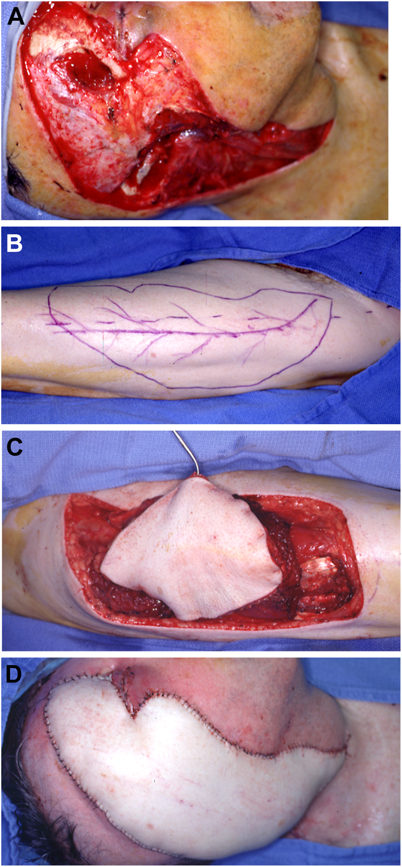 Three surgical photo series of an anterolateral thigh flap show an open wound on a face, a drawing on a person's leg, and a piece of skin lifted from the leg.