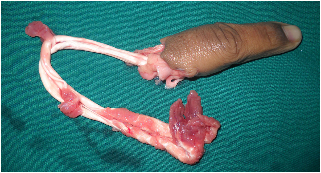A photo of a single finger avulsion amputation shows complete detachment with avulsion of flexor and extensor tendons at the musculotendinous level, a contraindication for replantation.