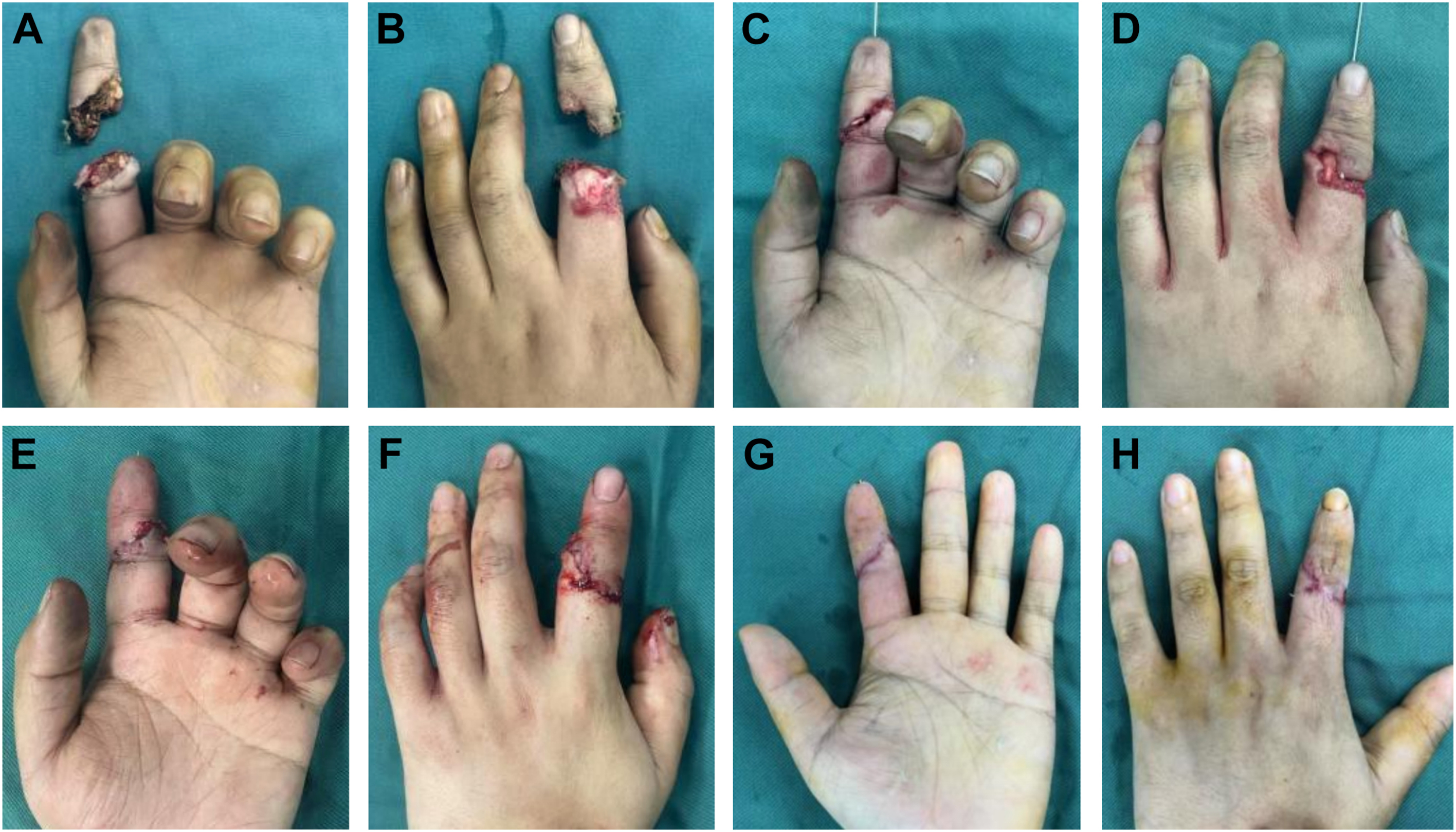 A series of eight hand injury photos show multiple finger amputations, surgical closure, and postoperative outcomes with stitches and healing stumps.