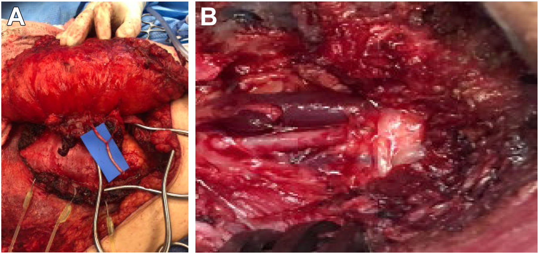 Two surgical photos show a nerve graft connected to a small nerve in the chest flap and a chest view showing a nerve passing across near visible blood vessels.