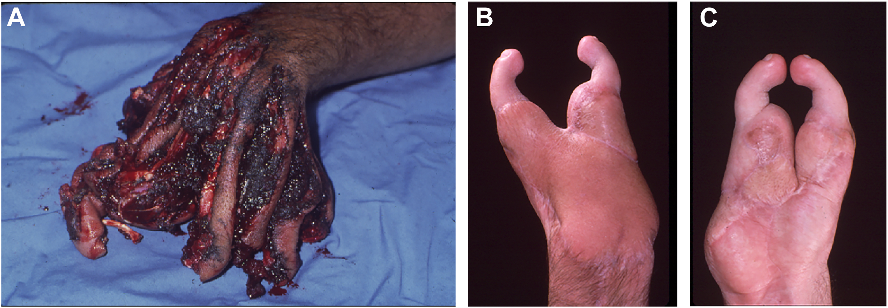 Three clinical photos show a severe hand injury and the same hand after surgical reconstruction.