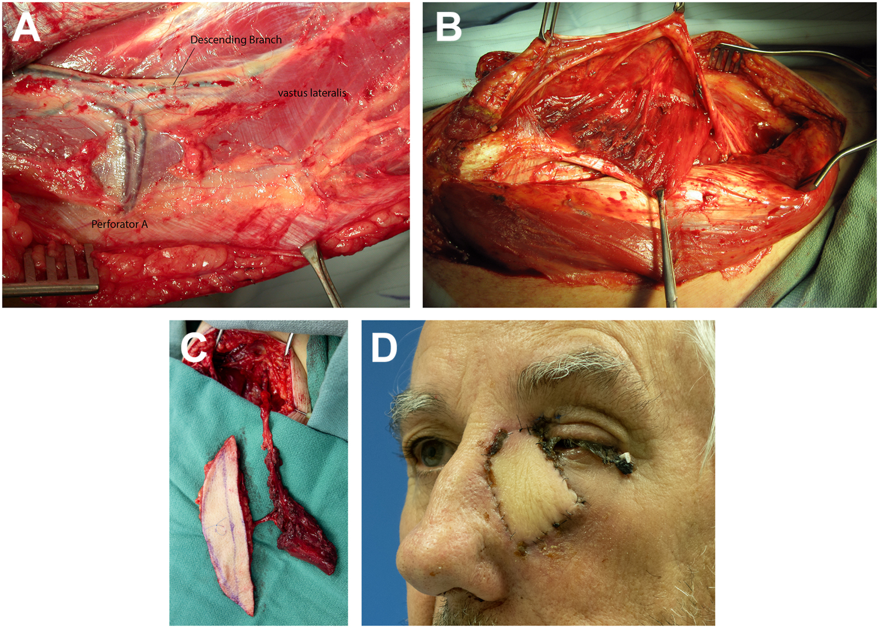 Four surgical photographs show the process of a thigh flap being harvested and used for facial reconstruction.