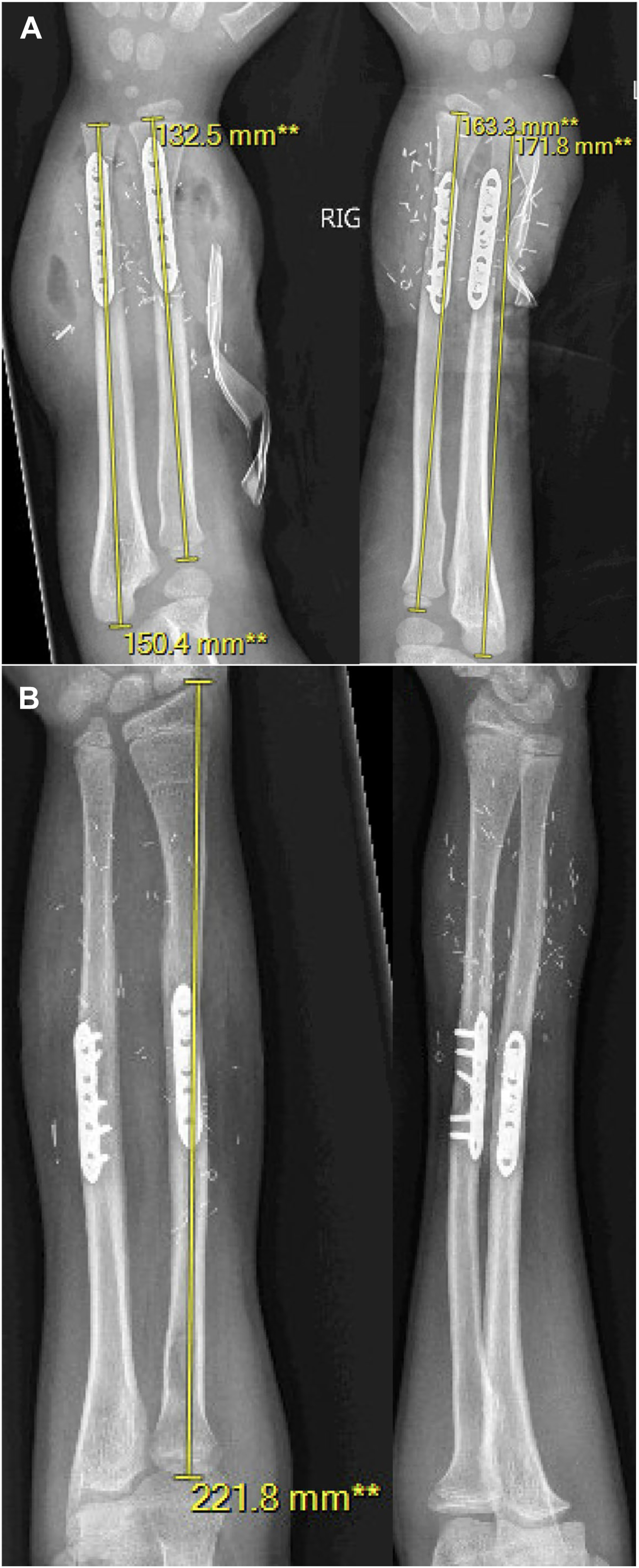A set of radiographs shows forearm transplantation with early fixation and long-term bone growth, demonstrating successful integration.