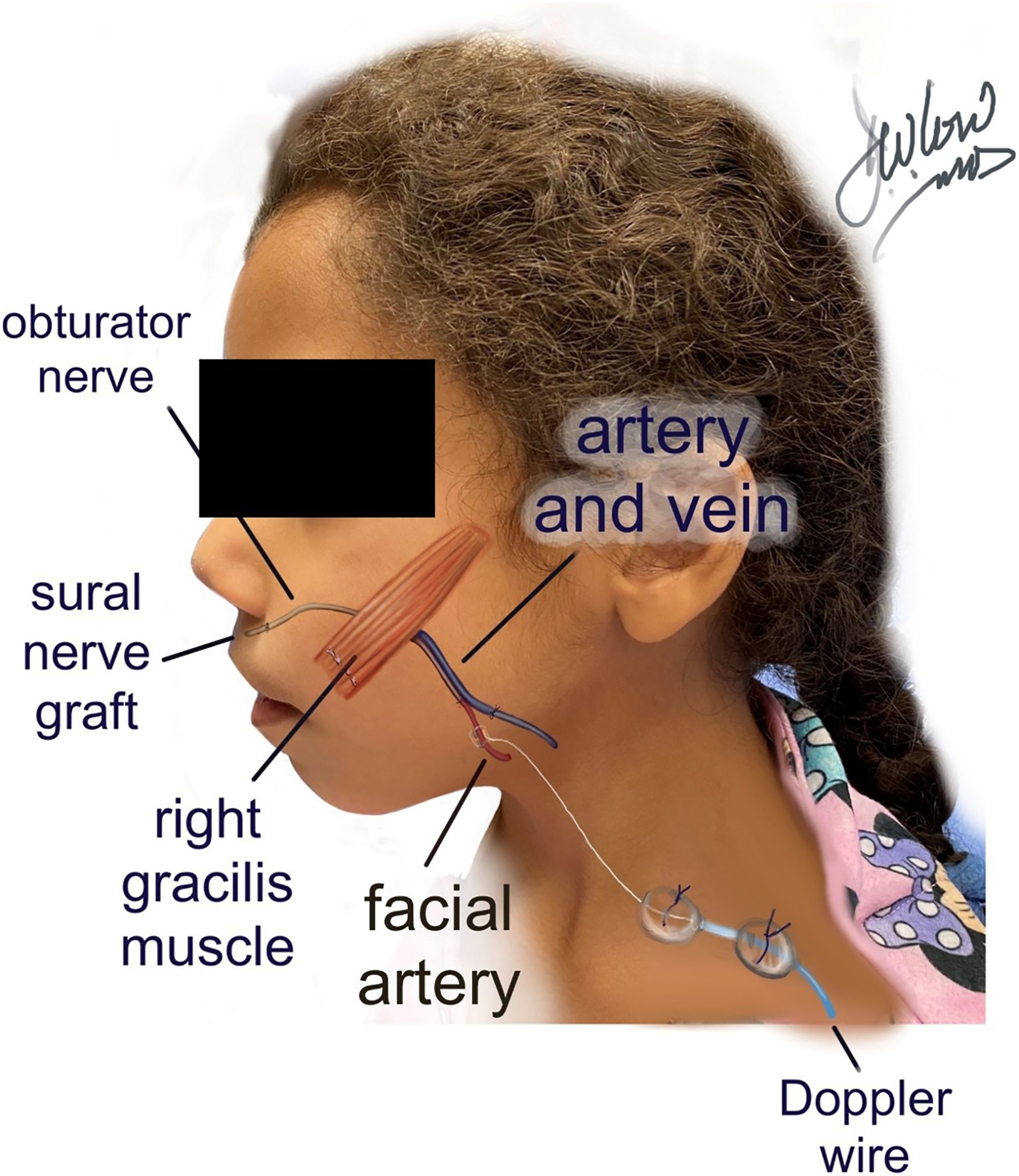 A diagram of a child shows nerve graft, gracilis muscle transfer, and vascular connections for facial reanimation.
