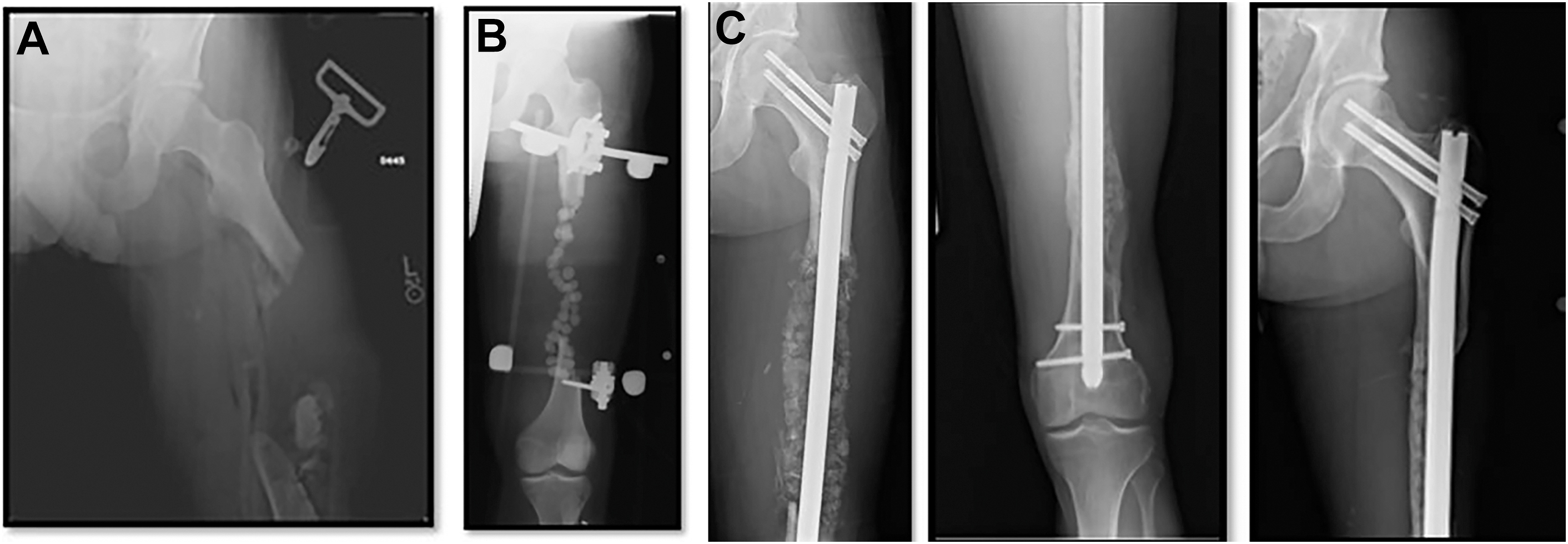 A set of three radiographs shows staged management of a large femoral bone gap with spacer placement, healing process, and internal fixation.