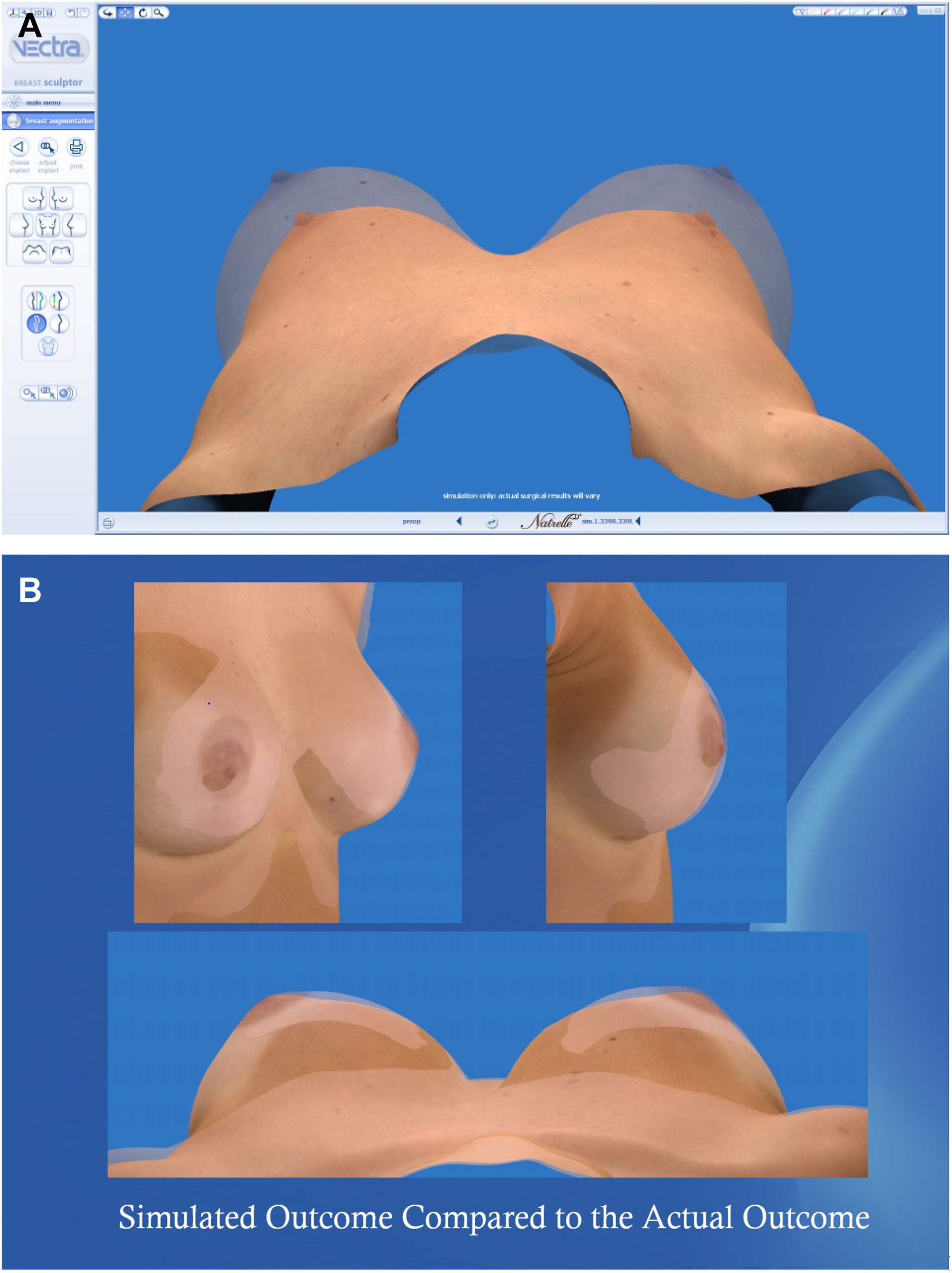 A set of panels shows preoperative simulations for breast augmentation. Top panel shows a ghosted view of a 350 c c implant, and bottom panel compares a 330 c c simulation to the actual outcome.