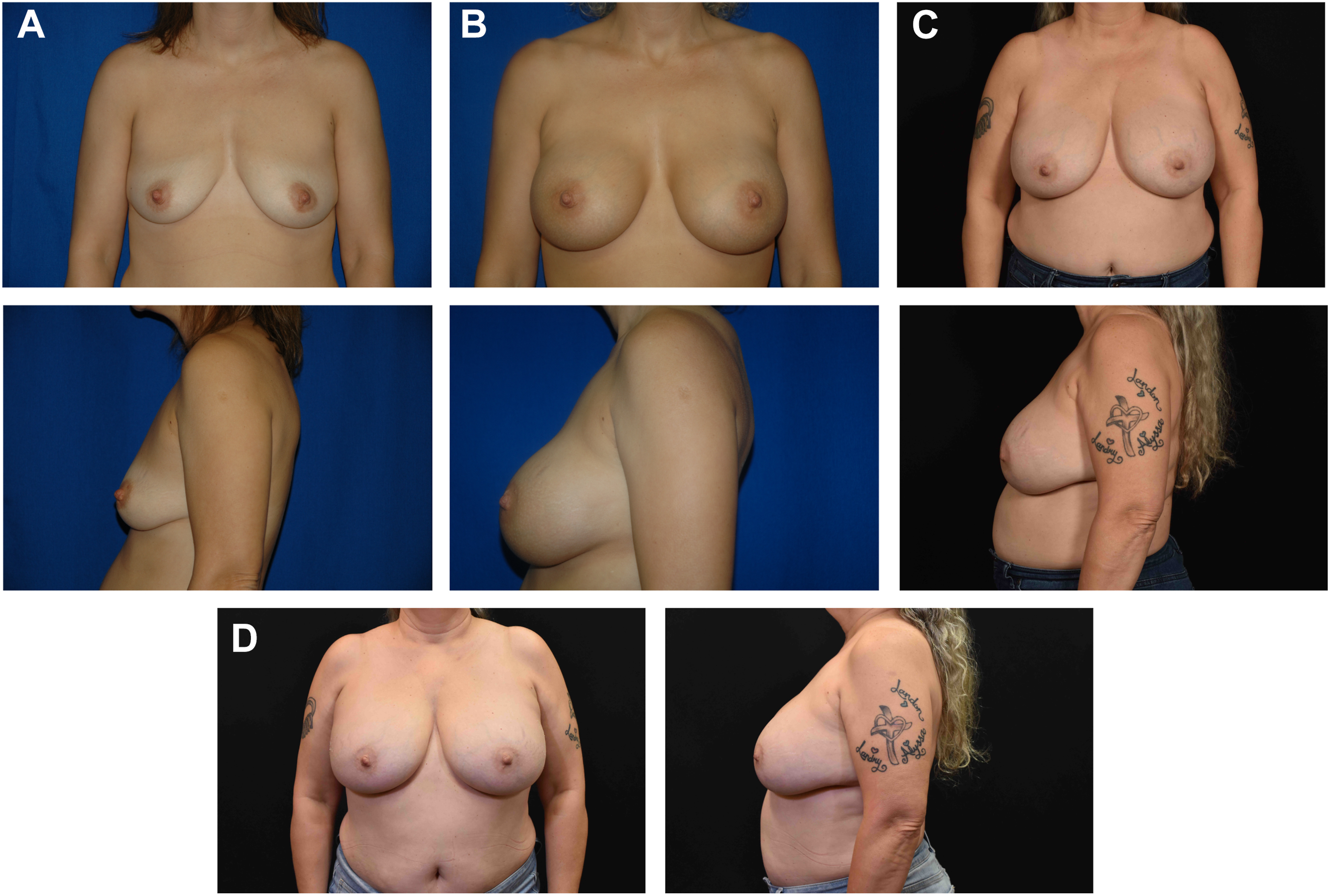 A set of photographs shows a woman before and after breast augmentation and subsequent revision surgeries in front and side views.