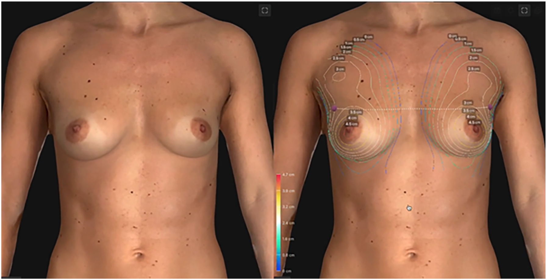 A pair of frontal views of a woman’s chest shows breast topography, with the right panel displaying contour lines and measurements.