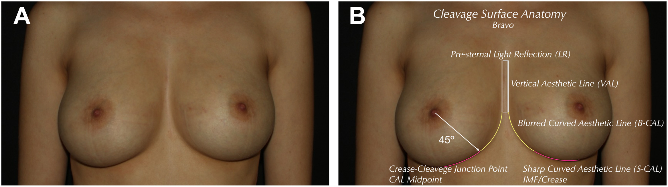 A pair of photographs shows a woman’s chest in a frontal view with natural cleavage and labeled surface anatomy lines.