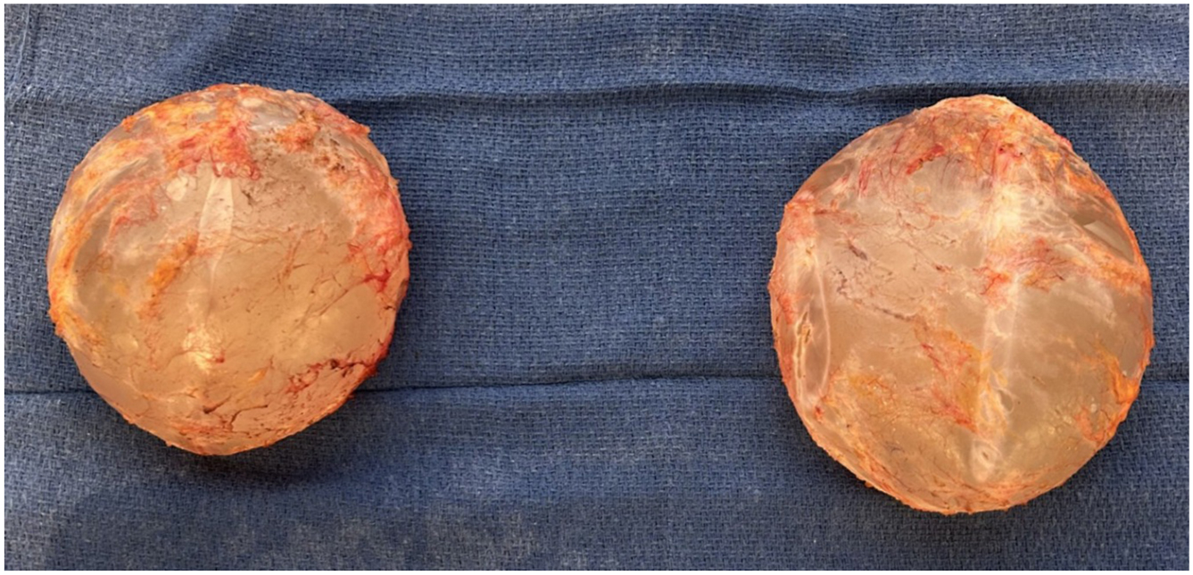 A pair of intact, rounded breast implant capsules rests side by side, showing fibrous tissue remnants on their outer surfaces.