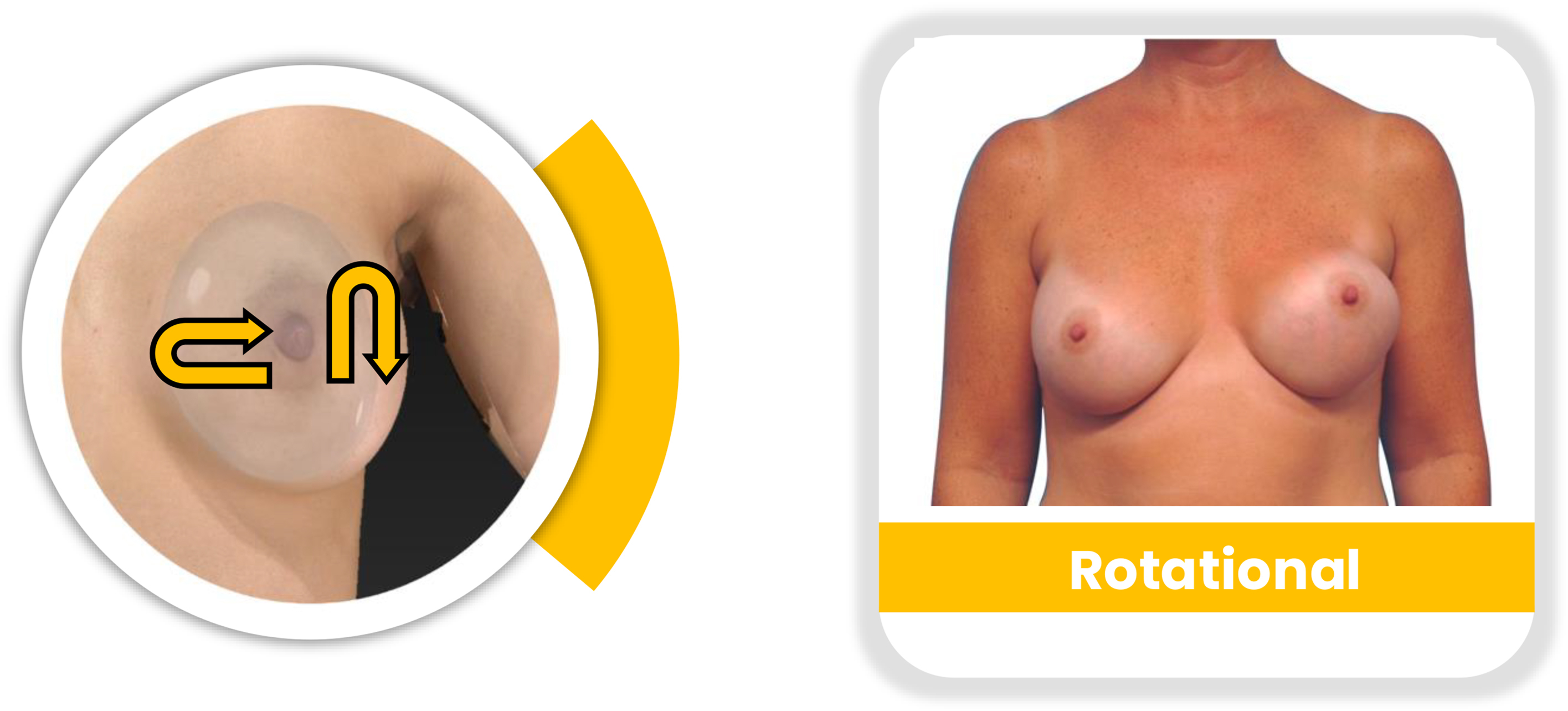 A set of two panels shows rotational breast implant malposition. An inset shows an arrow indicating a flip, and a photograph shows a misshapen, rotated implant on a person's chest.