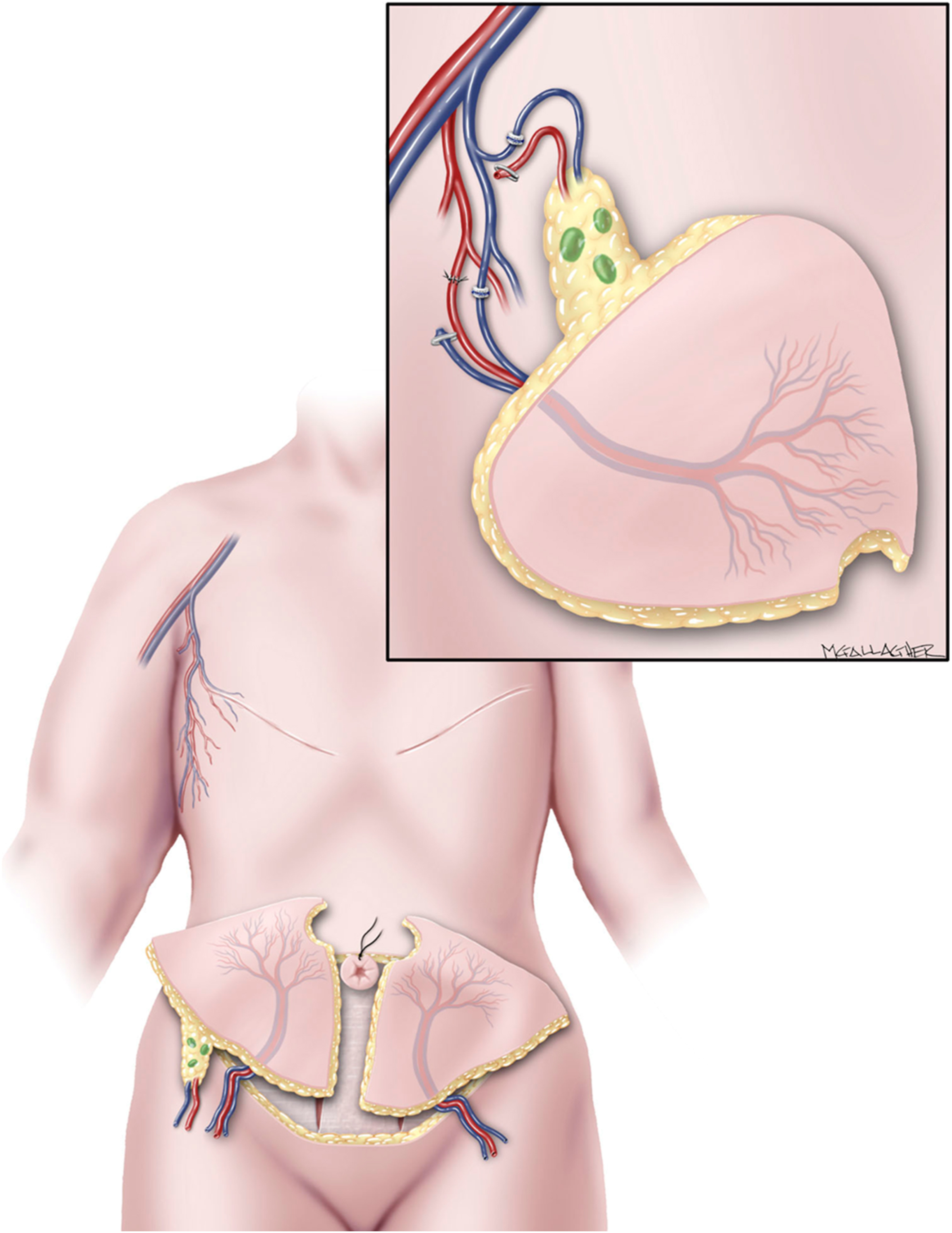 An anatomical illustration shows a vascularized omental flap from the abdomen with an inset highlighting vascular supply and lymphatic drainage.