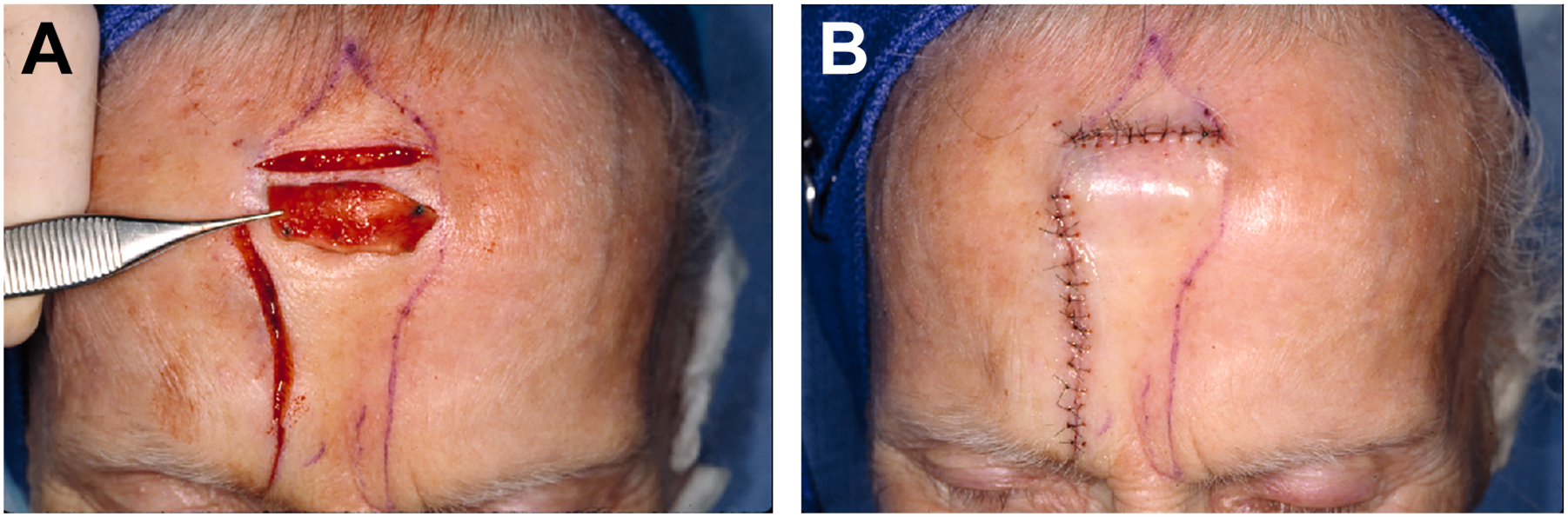 Two surgical images show a forehead flap procedure involving prelamination with a skin graft and post-operative closure.