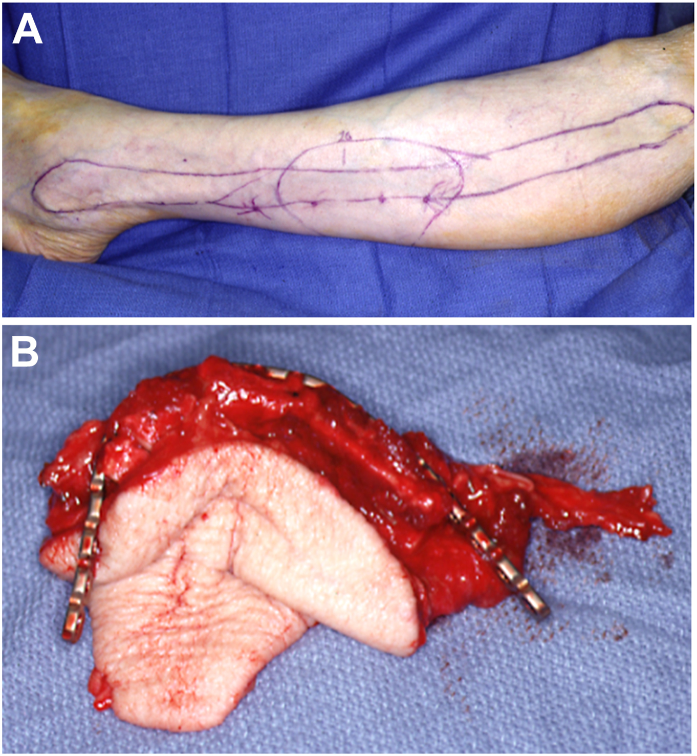 A two-part medical photo shows a leg with surgical markings and a bone with a metal plate.