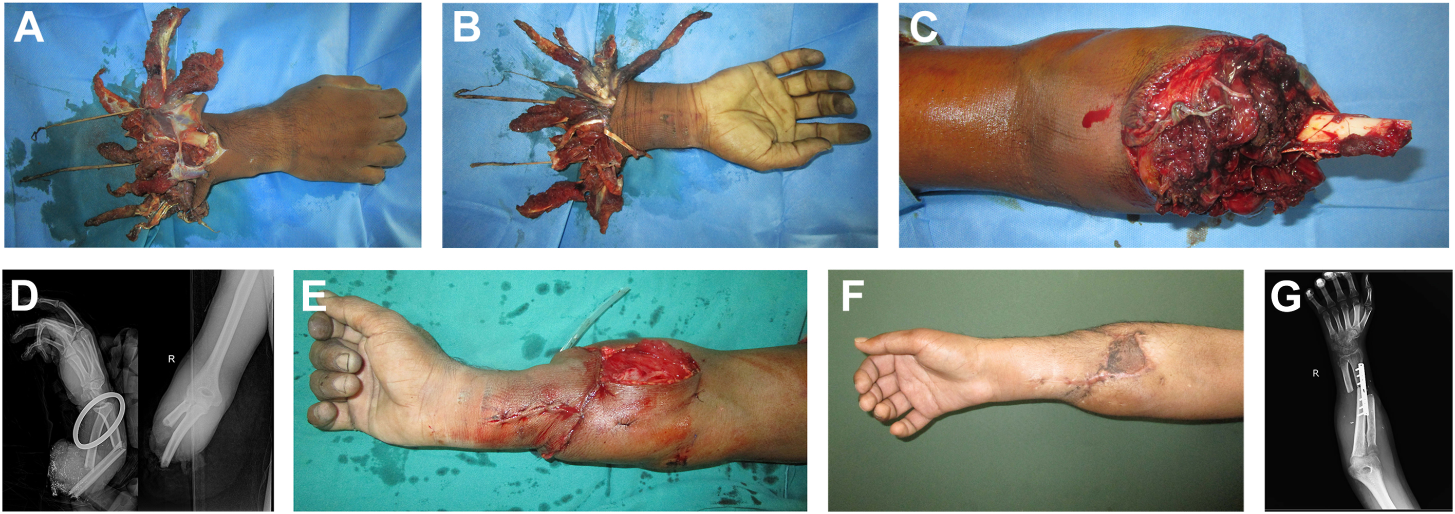 Seven panels depict crush avulsion amputation of the right forearm showing debridement, skeletal fixation with one bone forearm, and survival after replantation.