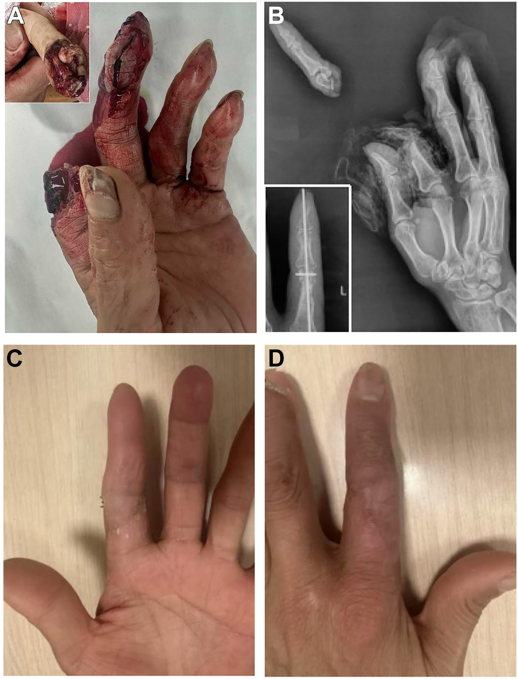 Four photos show a severe hand injury with exposed tissue, X-ray of amputated fingers, and later images of healed stumps after recovery.