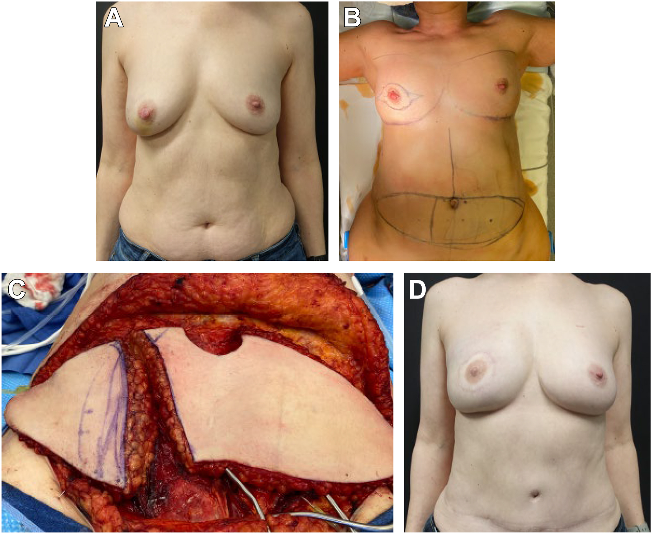 Four clinical photos show a woman before surgery with breast issues, pre-surgery markings on her chest and abdomen, surgery exposing tissue flaps, and a healed chest after reconstruction.
