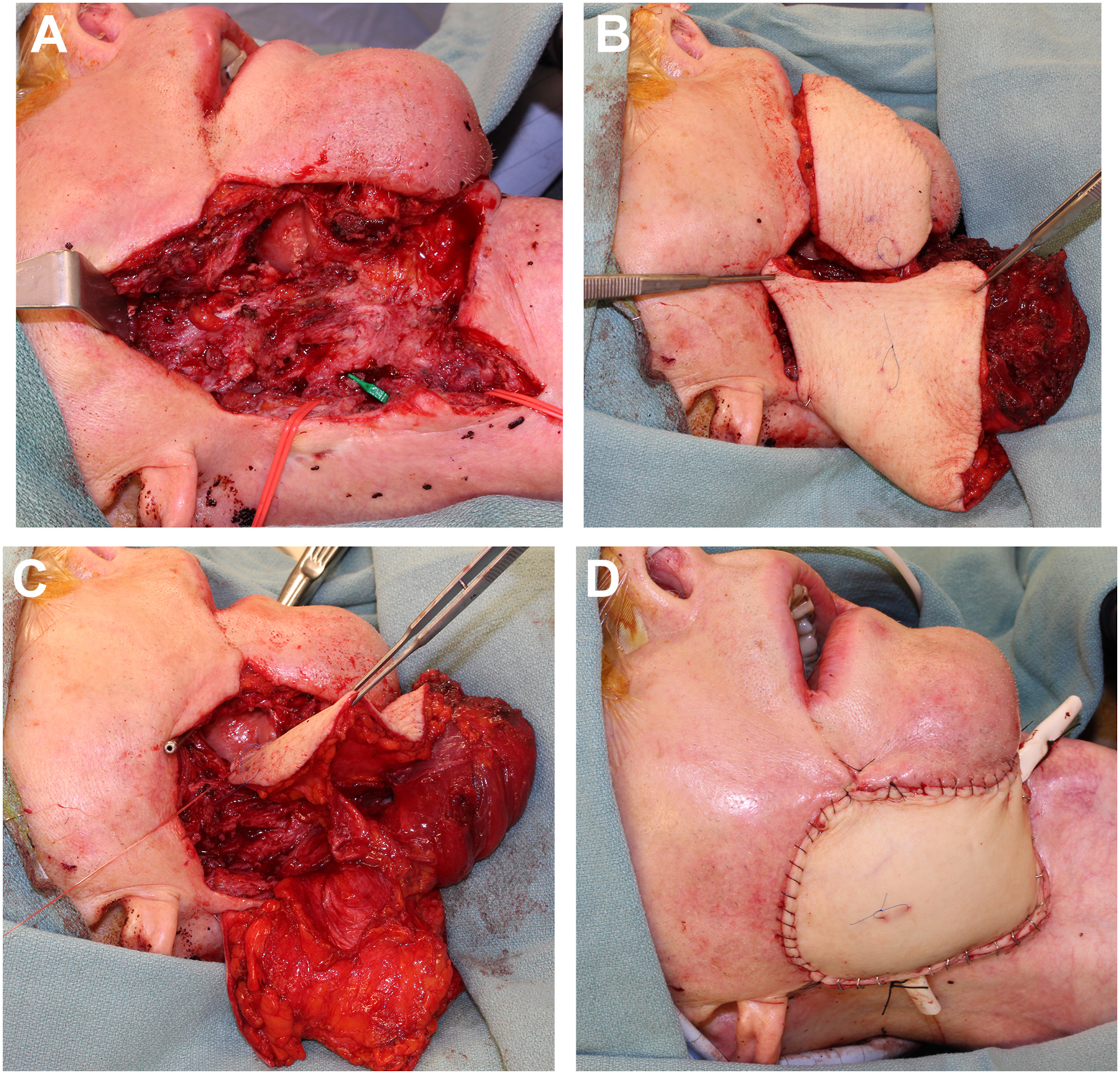 Four surgical photos show tissue taken from the thigh and shaped into two skin flaps for repairing both inside the mouth and the outer cheek.