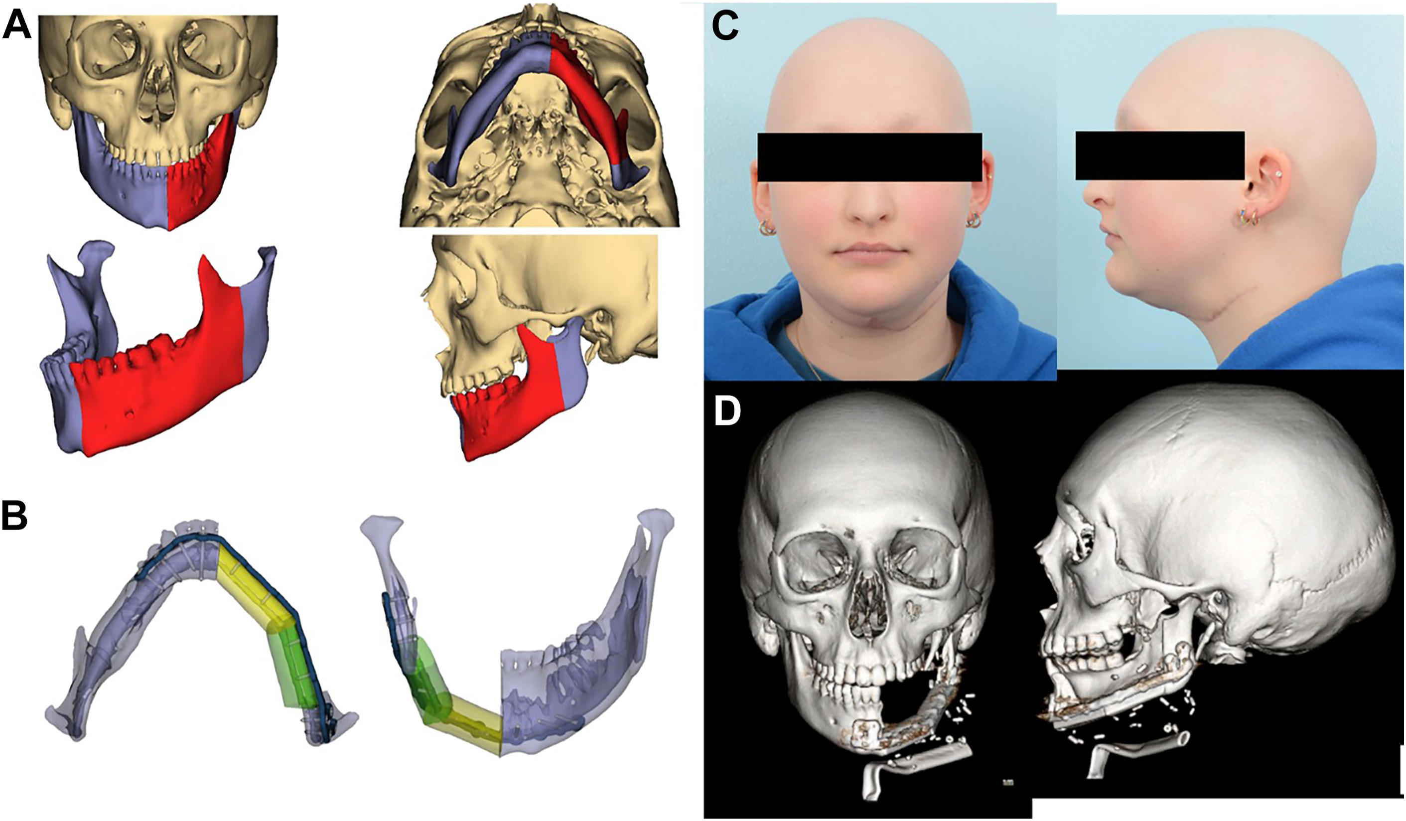 A set of clinical and 3-D reconstructions showing mandibular reconstruction with graft planning, patient photos, and postoperative skull scans.