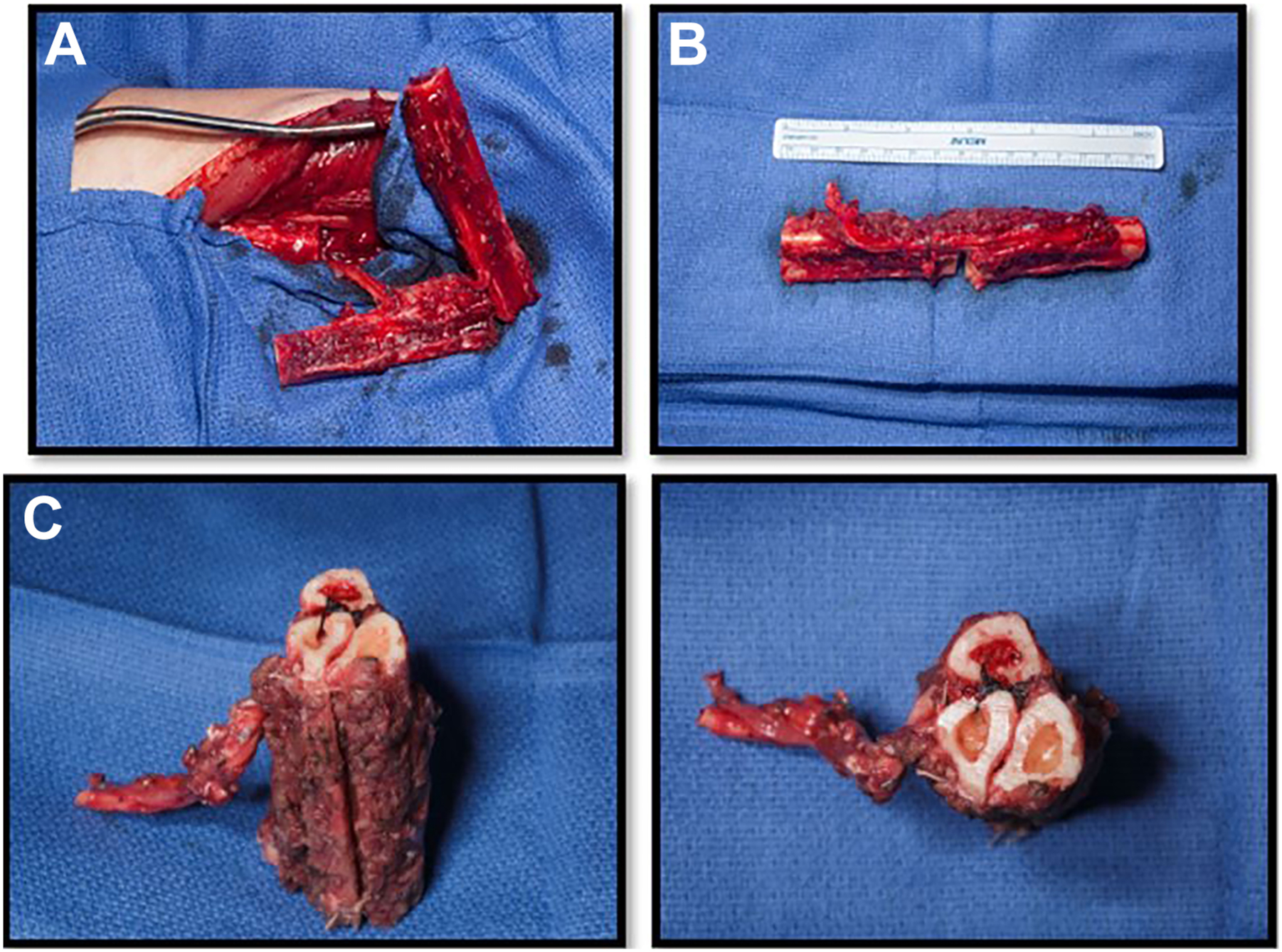 Four surgical photos show fibula preparation, removal in segments, and reconstruction arranged in a multi-barrel form.