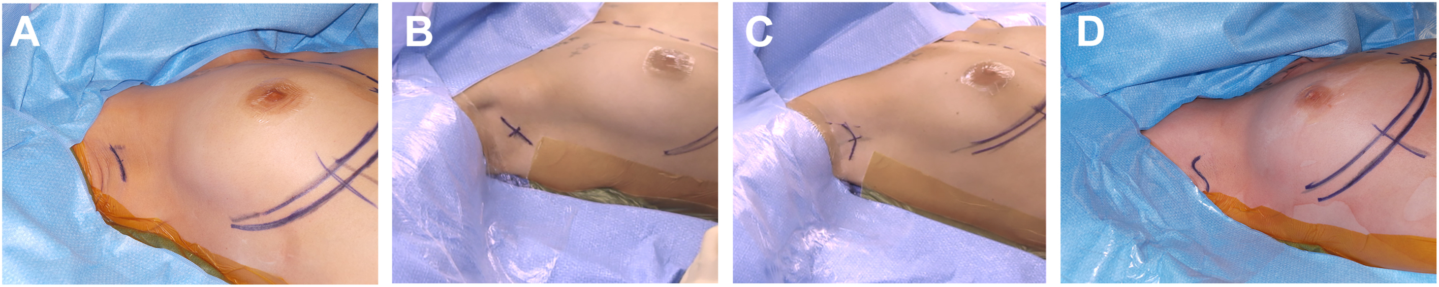 A set shows four panels, each depicting a different type of axillary incision for saline or silicone gel breast implants, with surgical markings on a patient's skin.