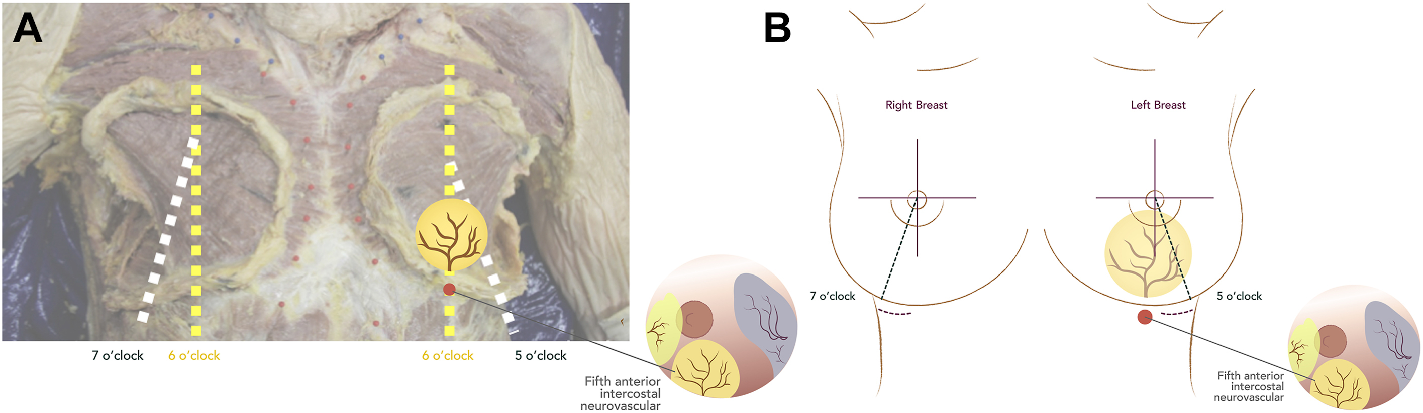 A pair of anatomical and schematic views illustrates the fifth anterior intercostal neurovascular branches near the 5 and 7 o’clock breast positions.