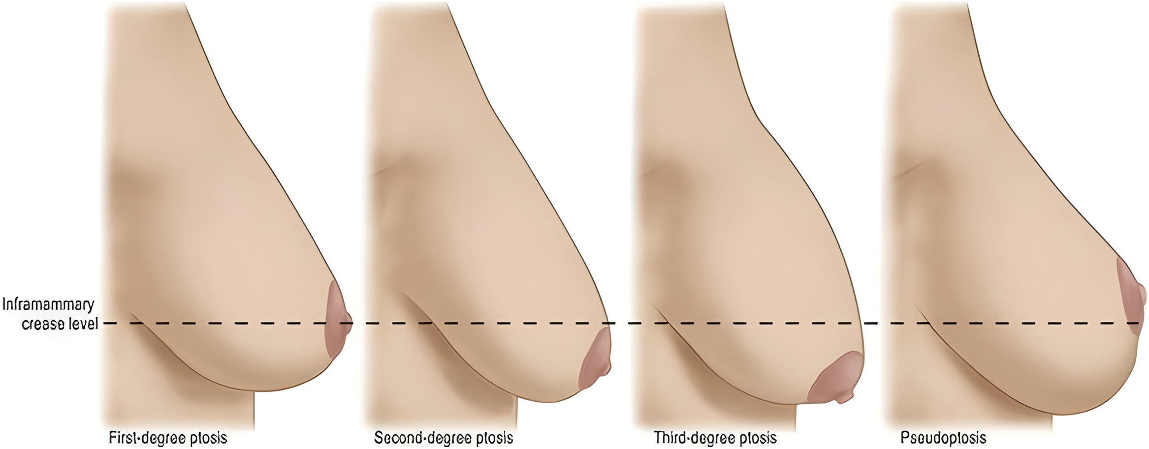 An illustration shows breast ptosis classification based on the position relative to the inframammary fold.
