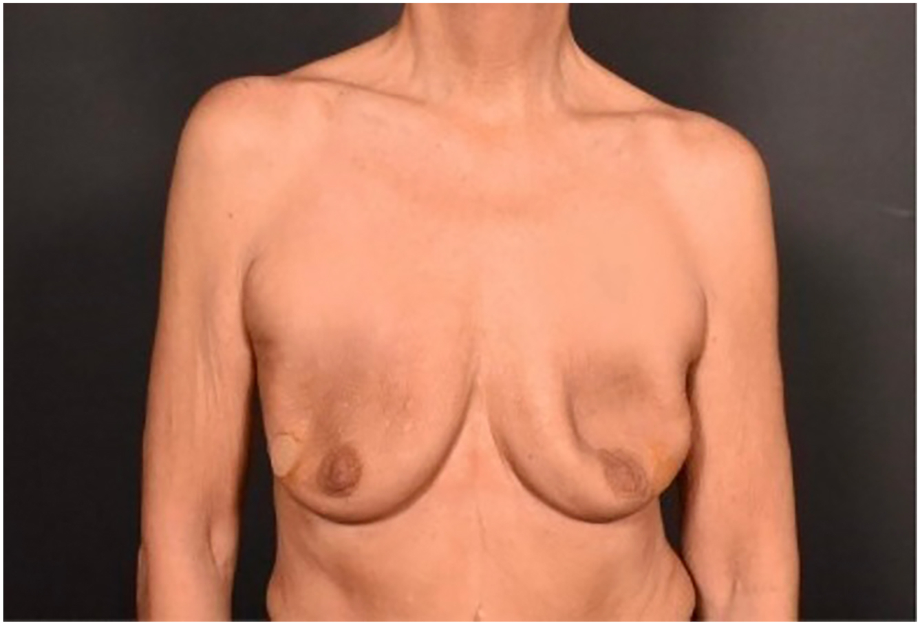 A frontal view of a woman’s chest shows the appearance of natural breasts following implant removal. The breasts display mild asymmetry, with slightly varied positioning and contour.