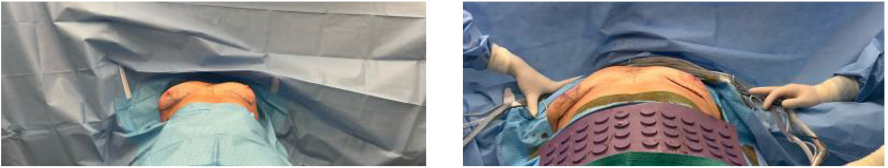 A set of two intraoperative photographs shows a patient's chest draped for surgery, demonstrating chest wall asymmetry from two different angles.