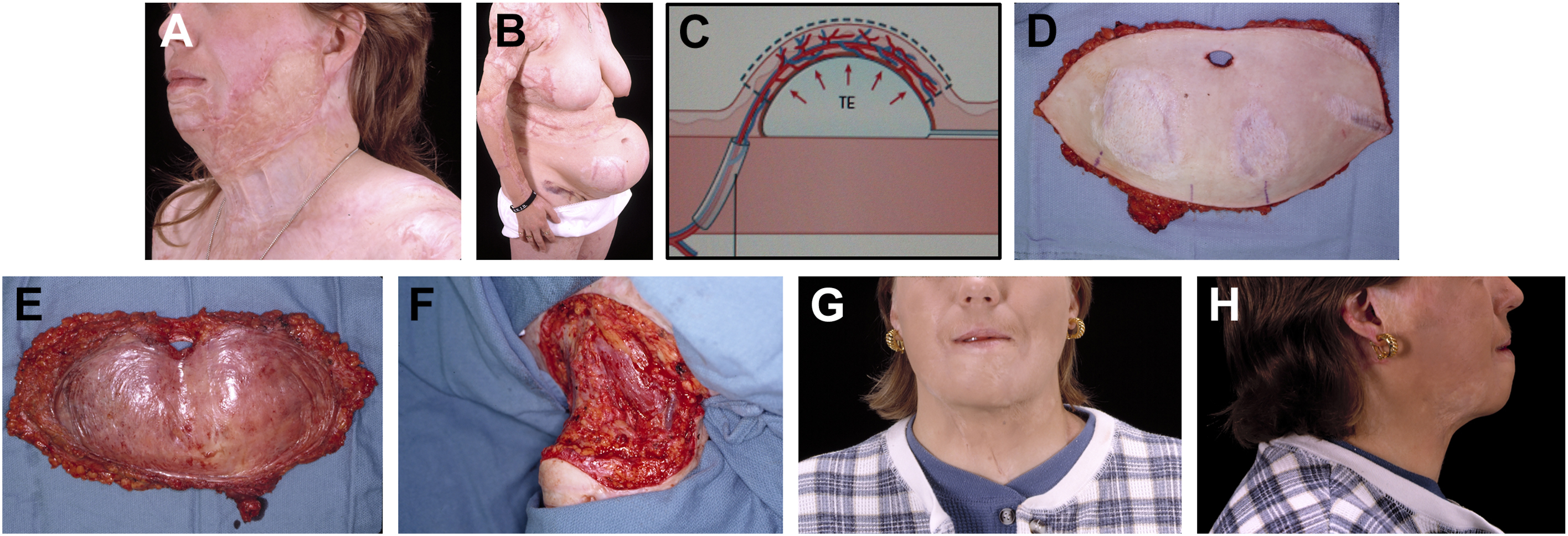 An 8-panel image series shows staged reconstruction of a scarred neck in a burn patient using expanded abdominal tissue.