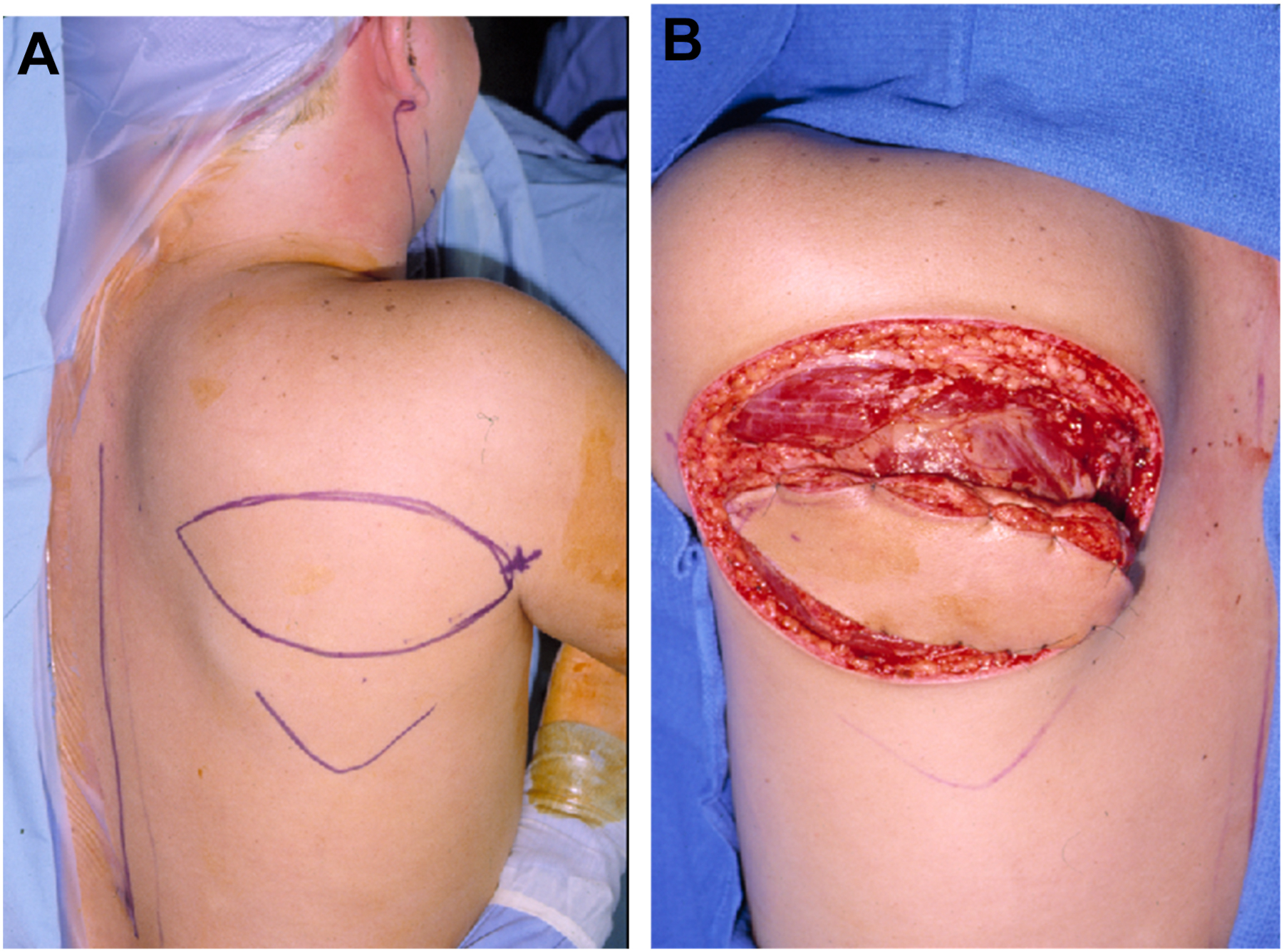 Two surgical photos show a scapular flap procedure with surgical lines and a piece of skin and tissue lifted from the back.