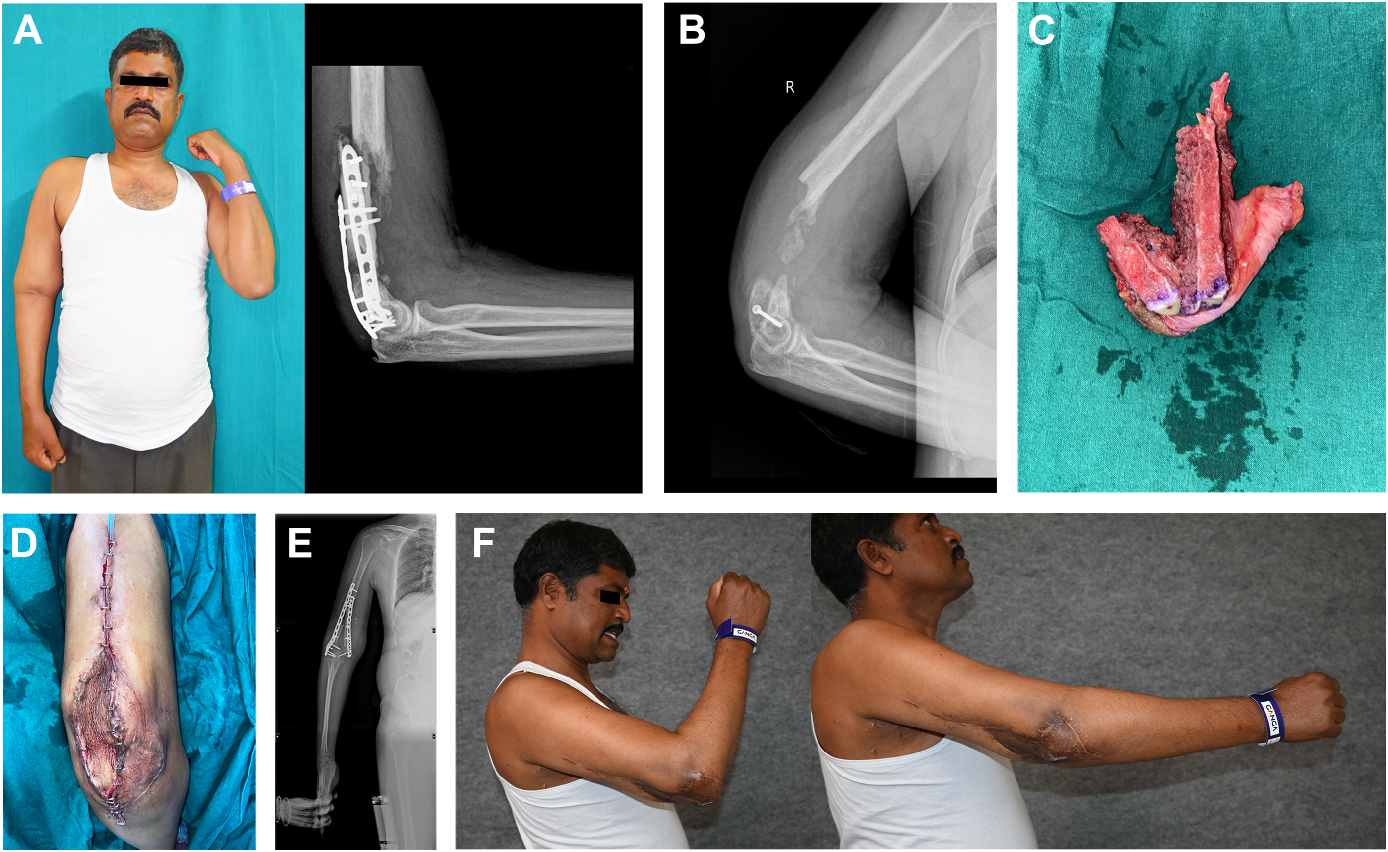Six panels depict an infective nonunion of the humerus treated with a fibula graft, showing healing and restoration of elbow movement after reconstruction.