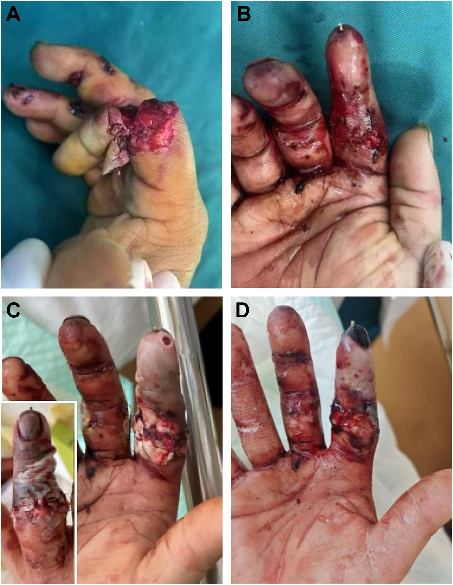 Four clinical photos of a hand injury show multiple crushed and lacerated fingers with exposed tissue, deep wounds, and early surgical management.