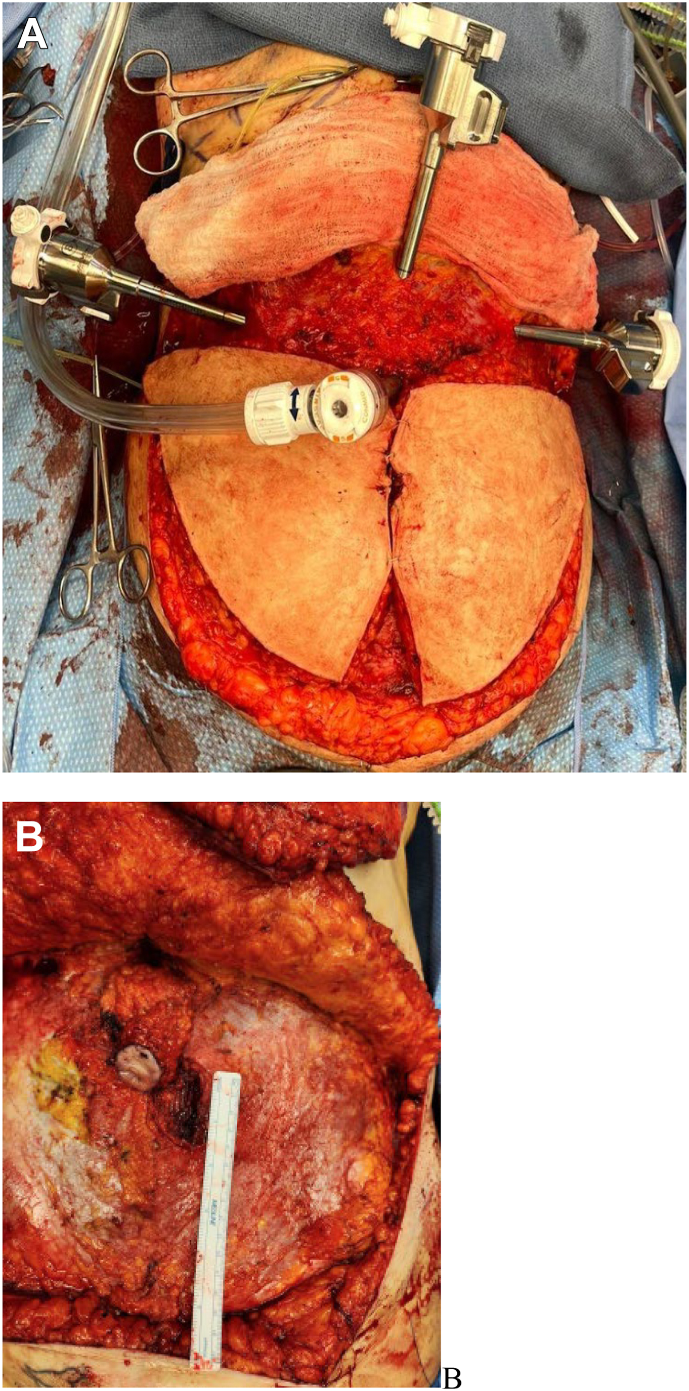 Two surgical photos show a surgical setup with robotic tools placed on the abdomen and a close-up of a small incision on tissue with a measuring scale.