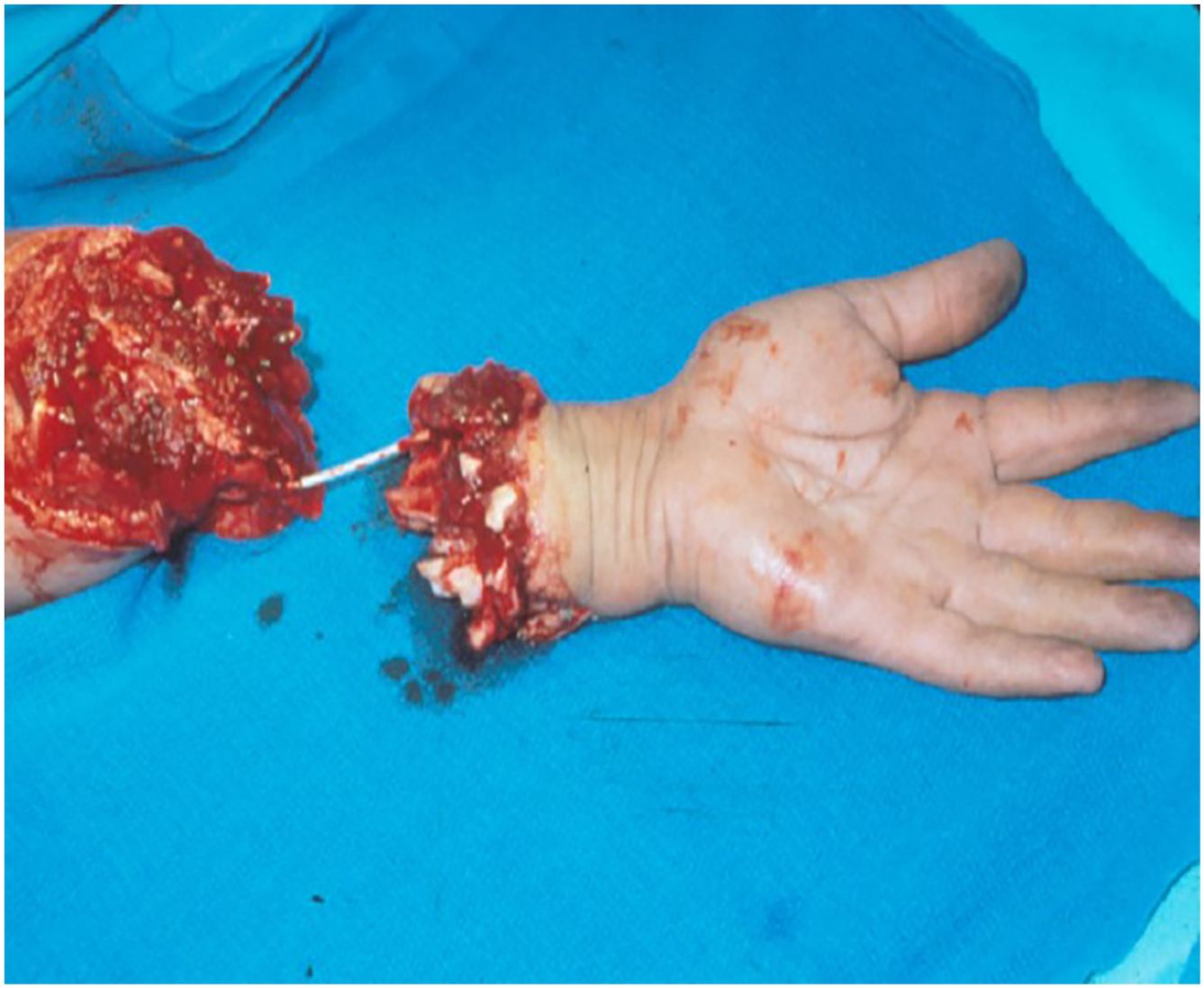 A clinical photo shows a severely injured wrist and forearm with a temporary tube connecting the vessels across the traumatic amputation site.