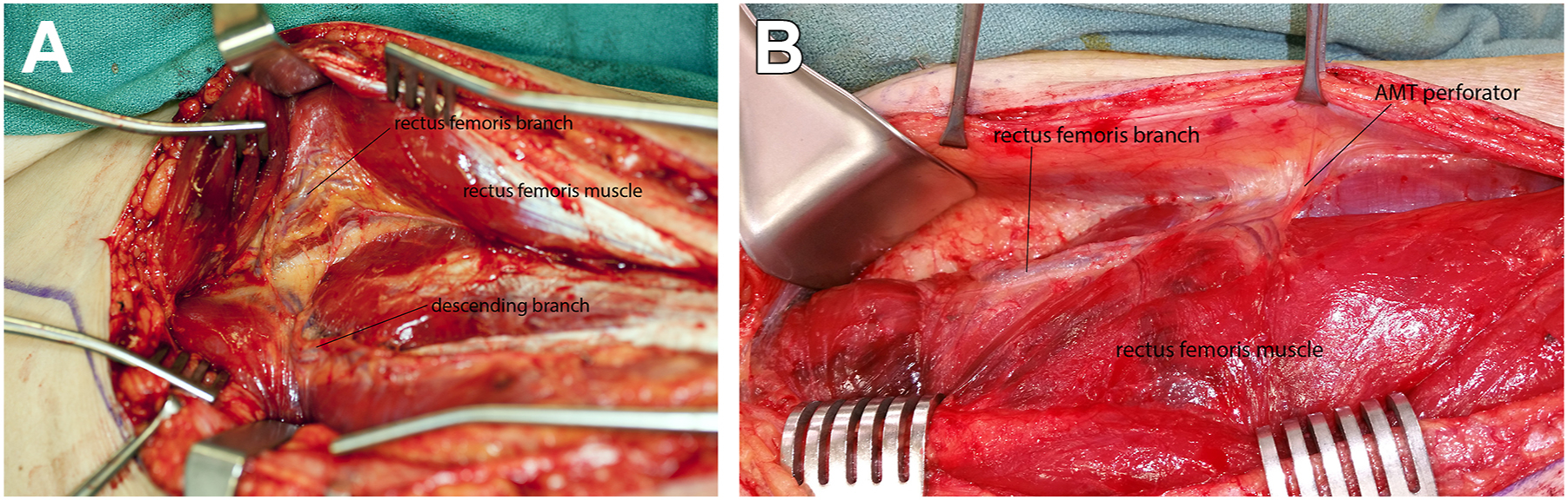 Two medical photos show the anatomy of the anteromedial thigh flap with the main vessel running beneath the rectus femoris muscle and tiny branches reaching the overlying skin.