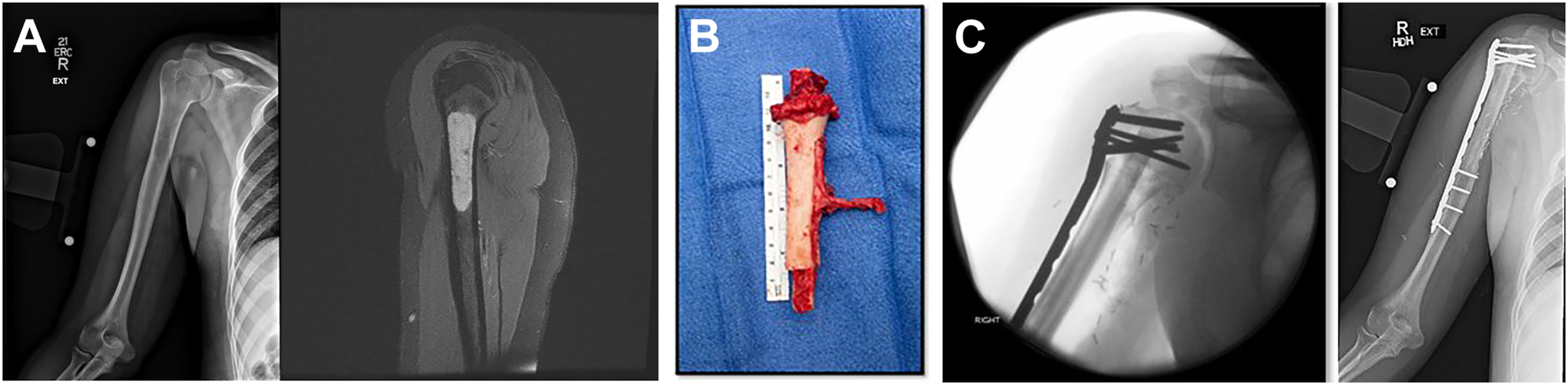 A set of radiographs and surgical photo show bone tumor management with fibula graft placement inside an allograft and follow-up healing.
