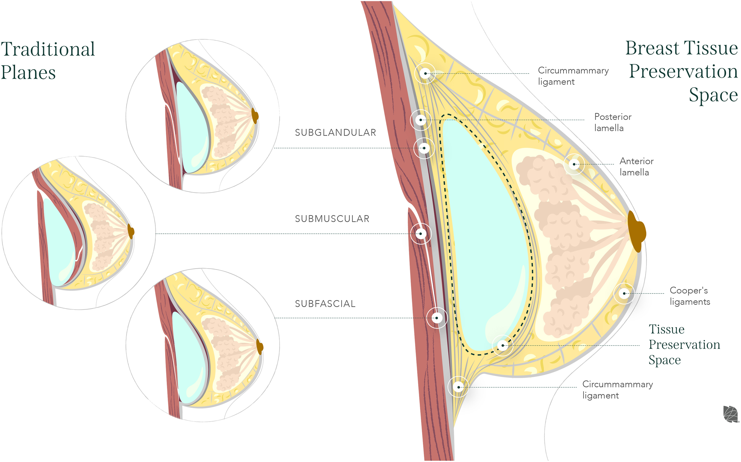 An illustration compares traditional breast implant placement planes with a breast tissue preservation space.