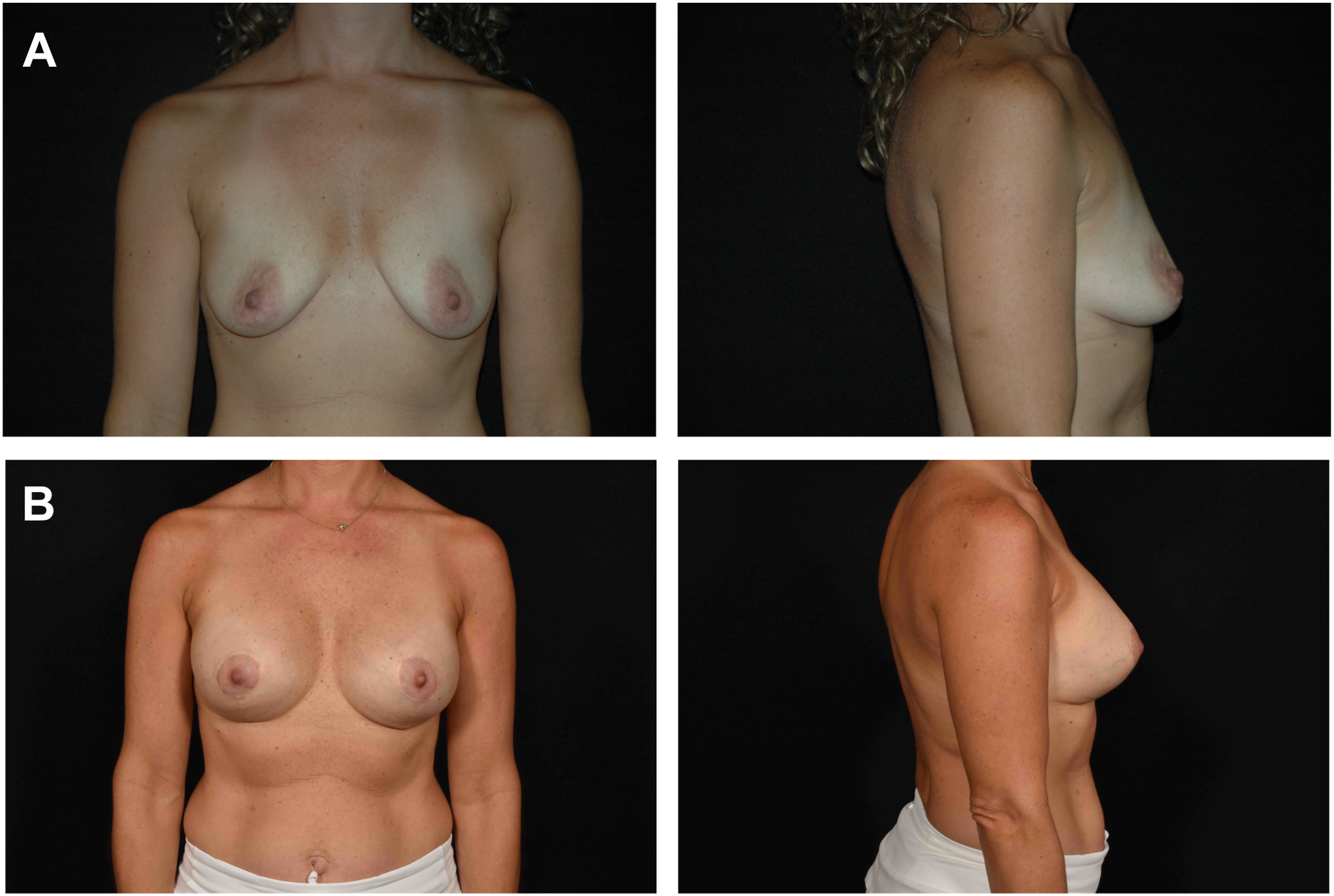 A set of four photographs shows a breast augmentation. The top row is the preoperative view showing pseudoptosis, and the bottom row is the nine year postoperative result.