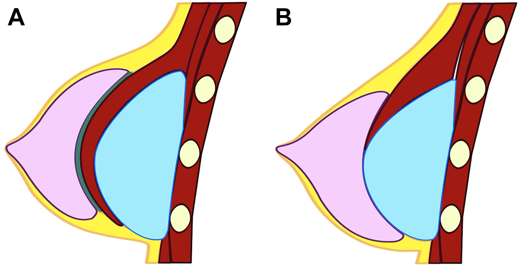 A diagram set shows side views of breast implant placements with differences in contour and projection.