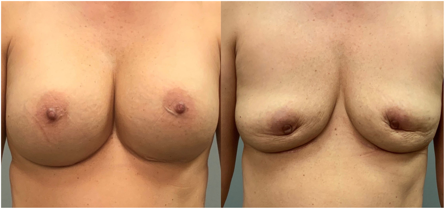 A pair of frontal views of a woman’s chest show a comparison before and after implant removal.
