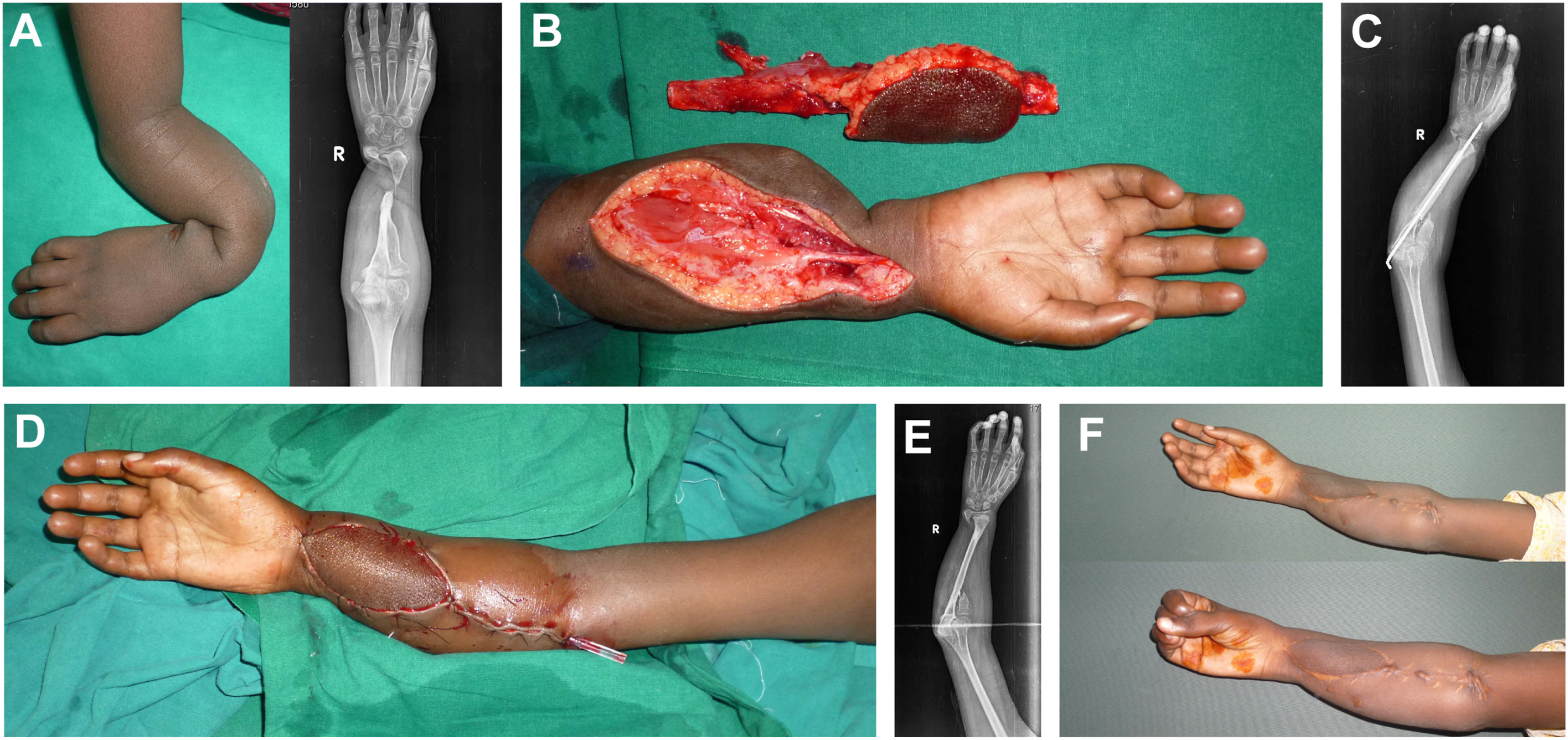 Six panels depict post-osteomyelitis non-union of forearm bones in a child treated with a free fibula flap and intramedullary pin, resulting in a one-bone forearm and a good outcome.
