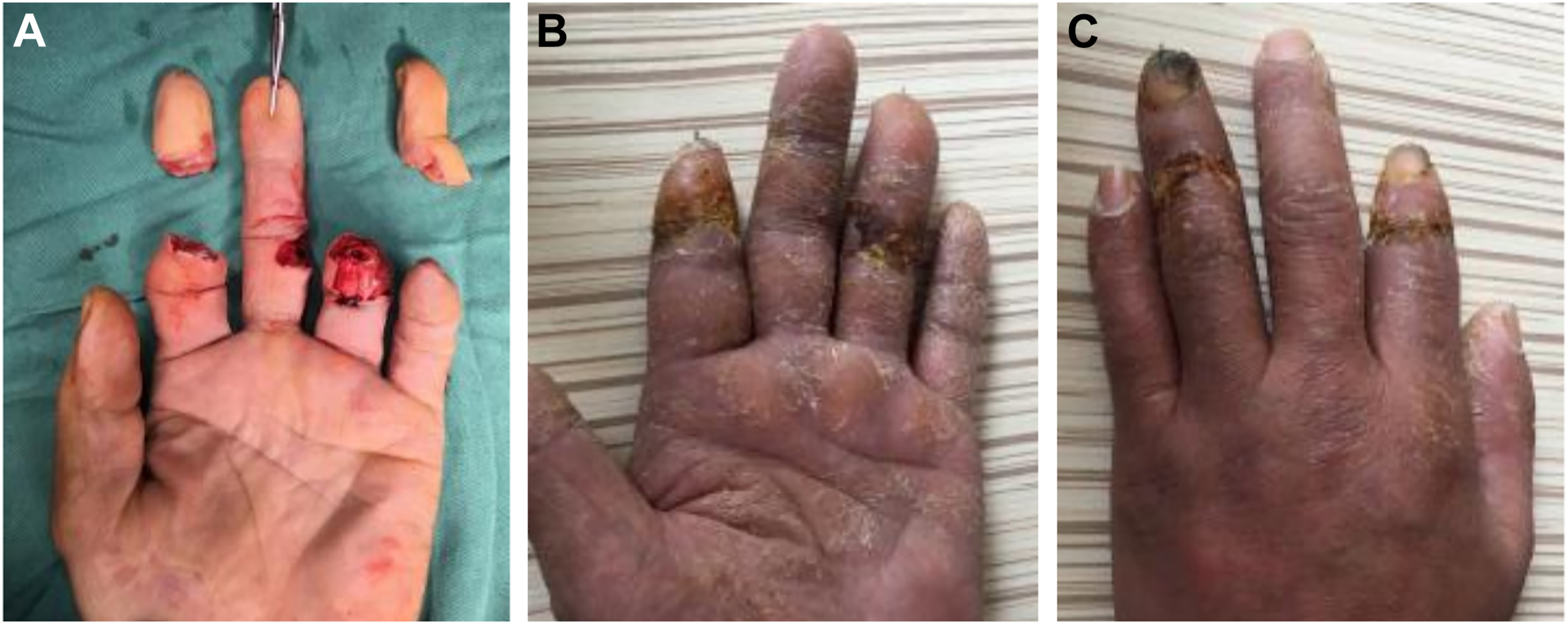 Three photos of hand injury photos show finger amputations with surgical wounds, followed by healed stumps with thickened skin and scarring.