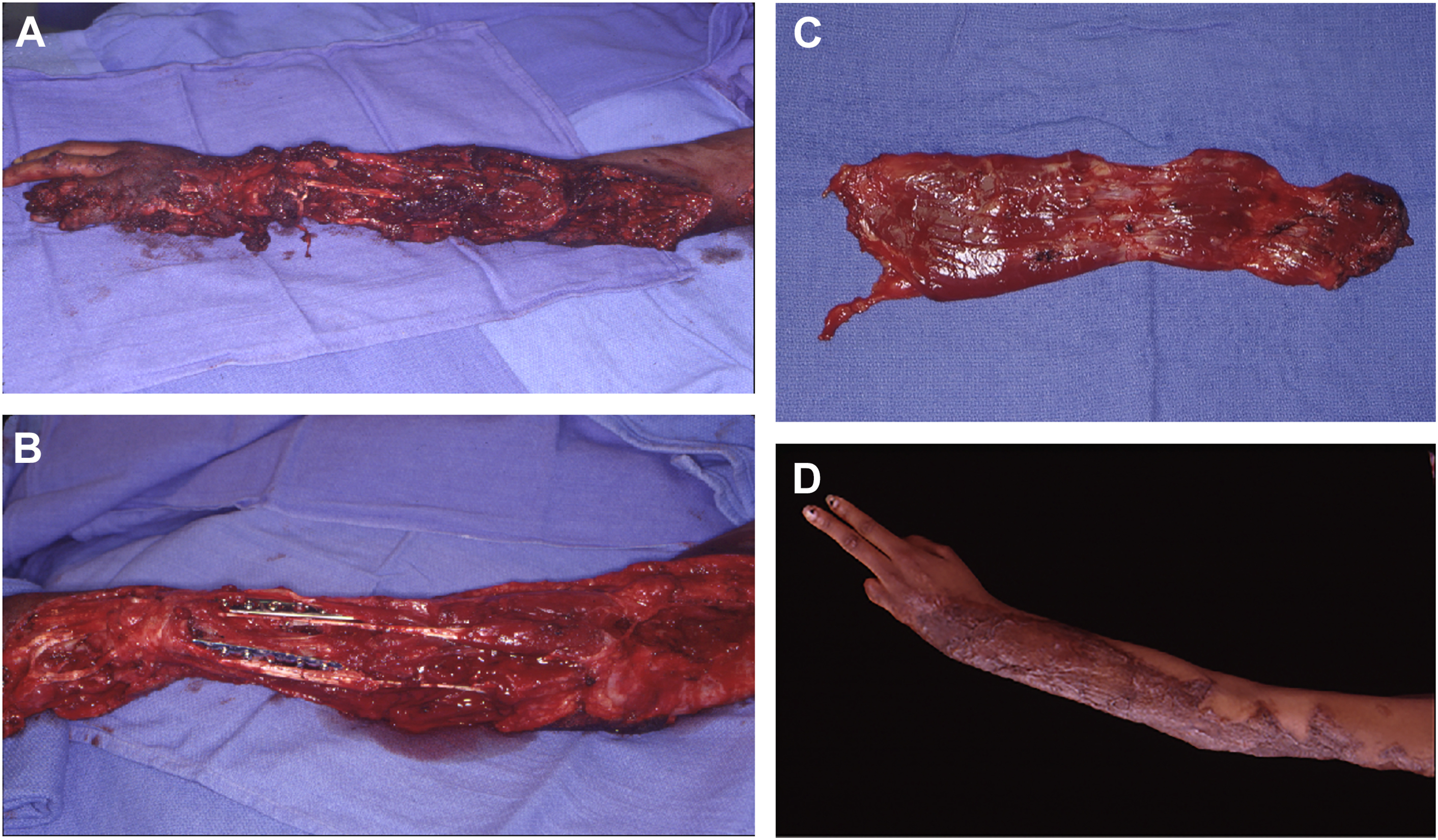 Four intraoperative photos show the debridement of a severely traumatized forearm and hand, removing damaged tissue and preparing for subsequent reconstruction.