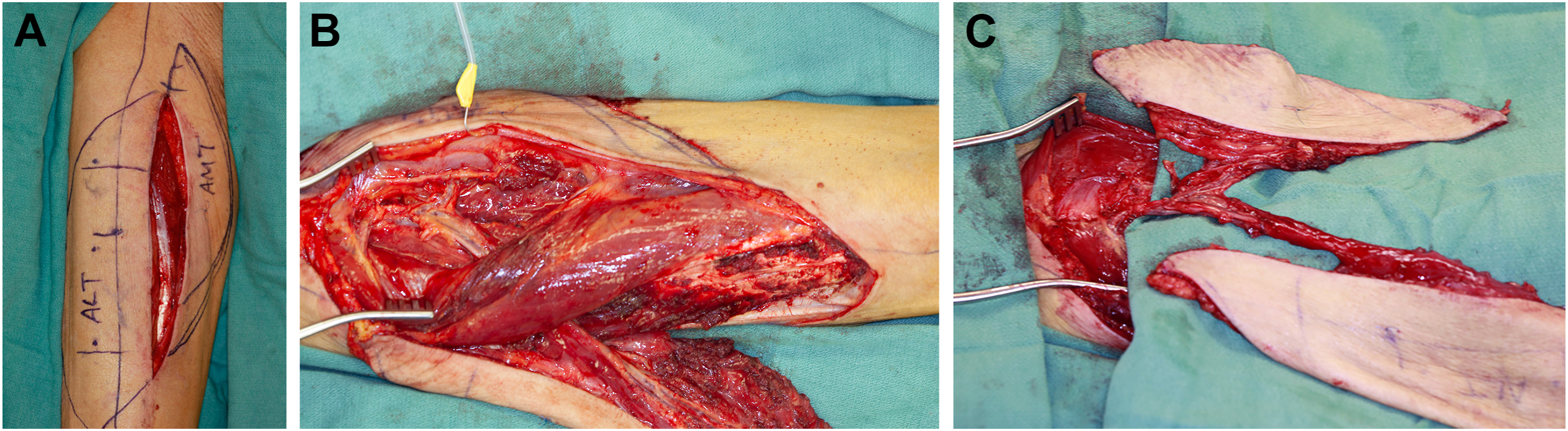 Three surgical photos show a combined anterolateral thigh (A L T) and anteromedial thigh (A M T) flap being prepared for a surgical procedure.