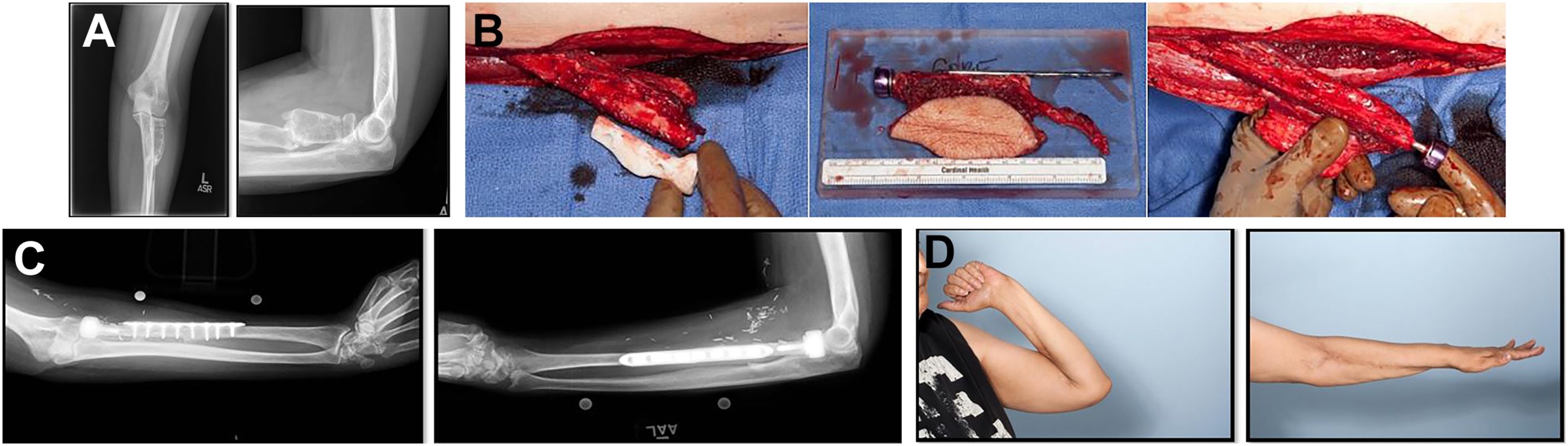 A set of radiographs, surgical photos, and clinical follow-up views showing reconstruction of the proximal radius with graft and prosthesis.