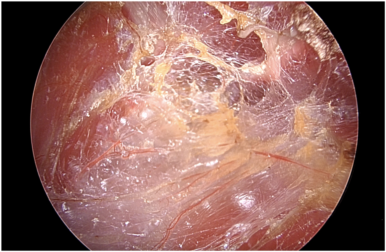 An endoscopic view shows the initial dissection in the subpectoral space of the right breast pocket, with medial to the left and lateral to the right.