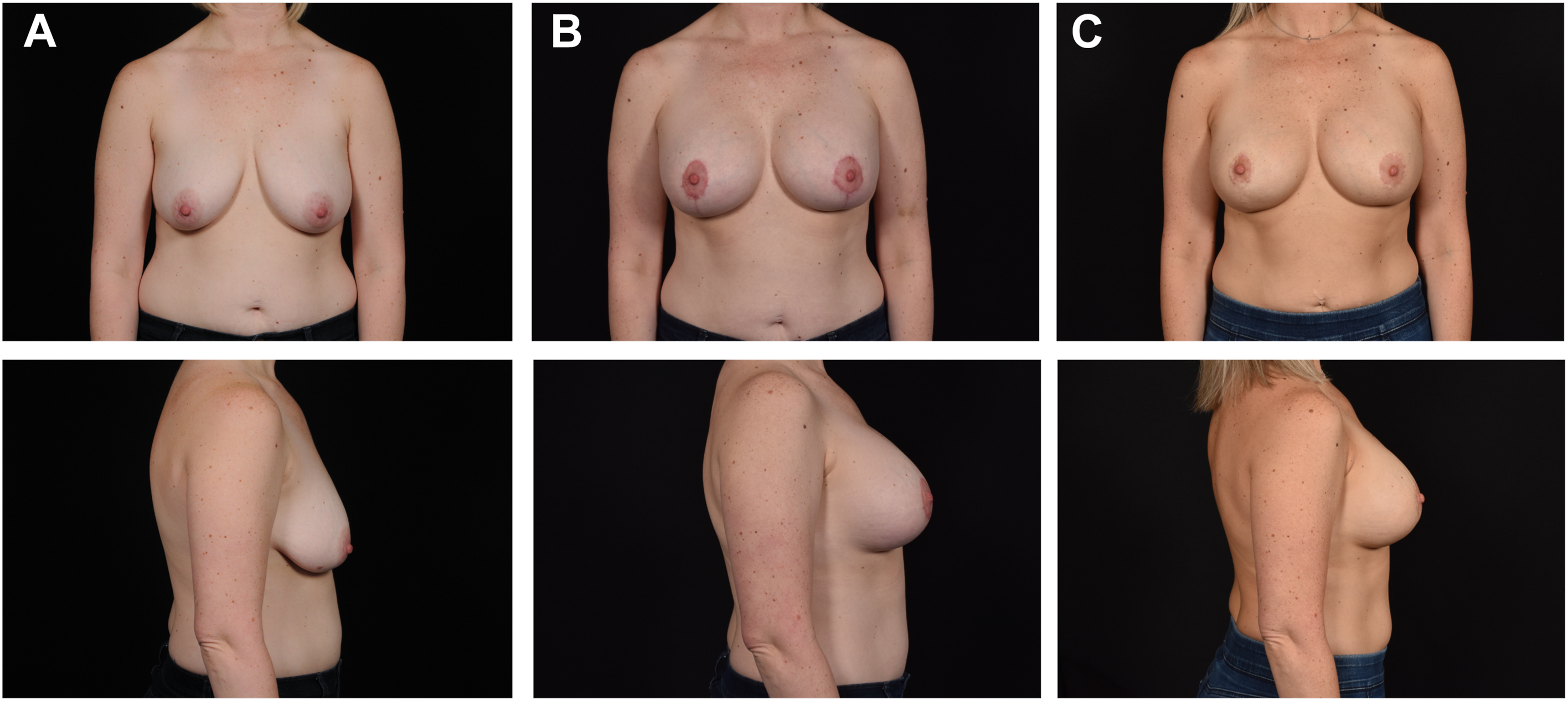 A set of photographs shows a woman before and after breast augmentation with mastopexy in front and side views.