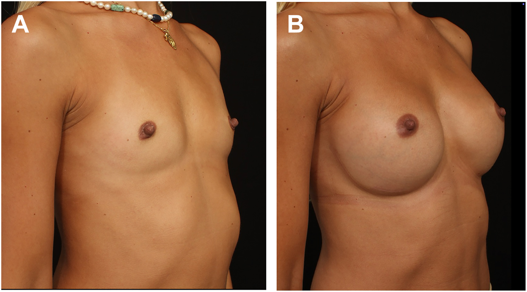 A pair of three quarter views of a woman before and after breast augmentation shows a natural teardrop contour.